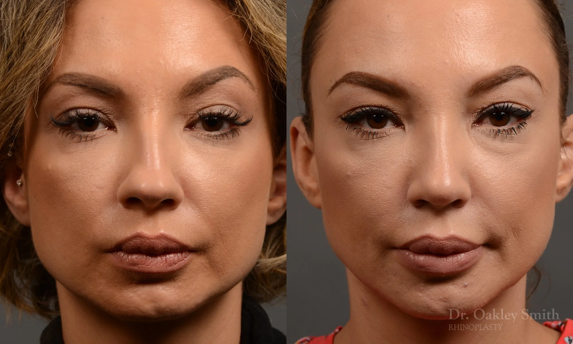 354A-rhinoplasty-dr-oakley-smith-toronto-nose-job.jpg