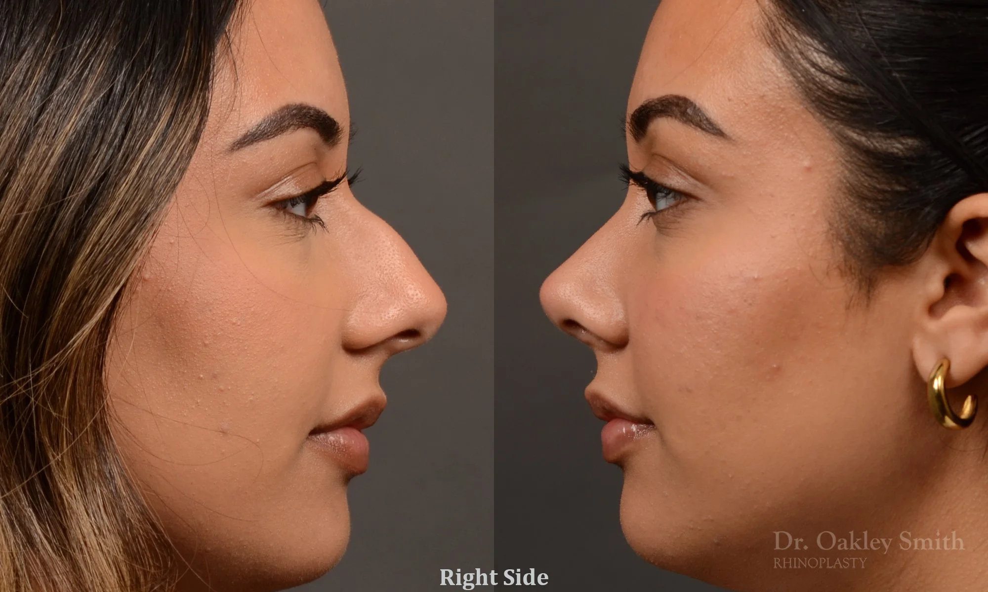 523- Female, Ethnic Rhinoplasty, Dorsal Hump, Tip Refinement