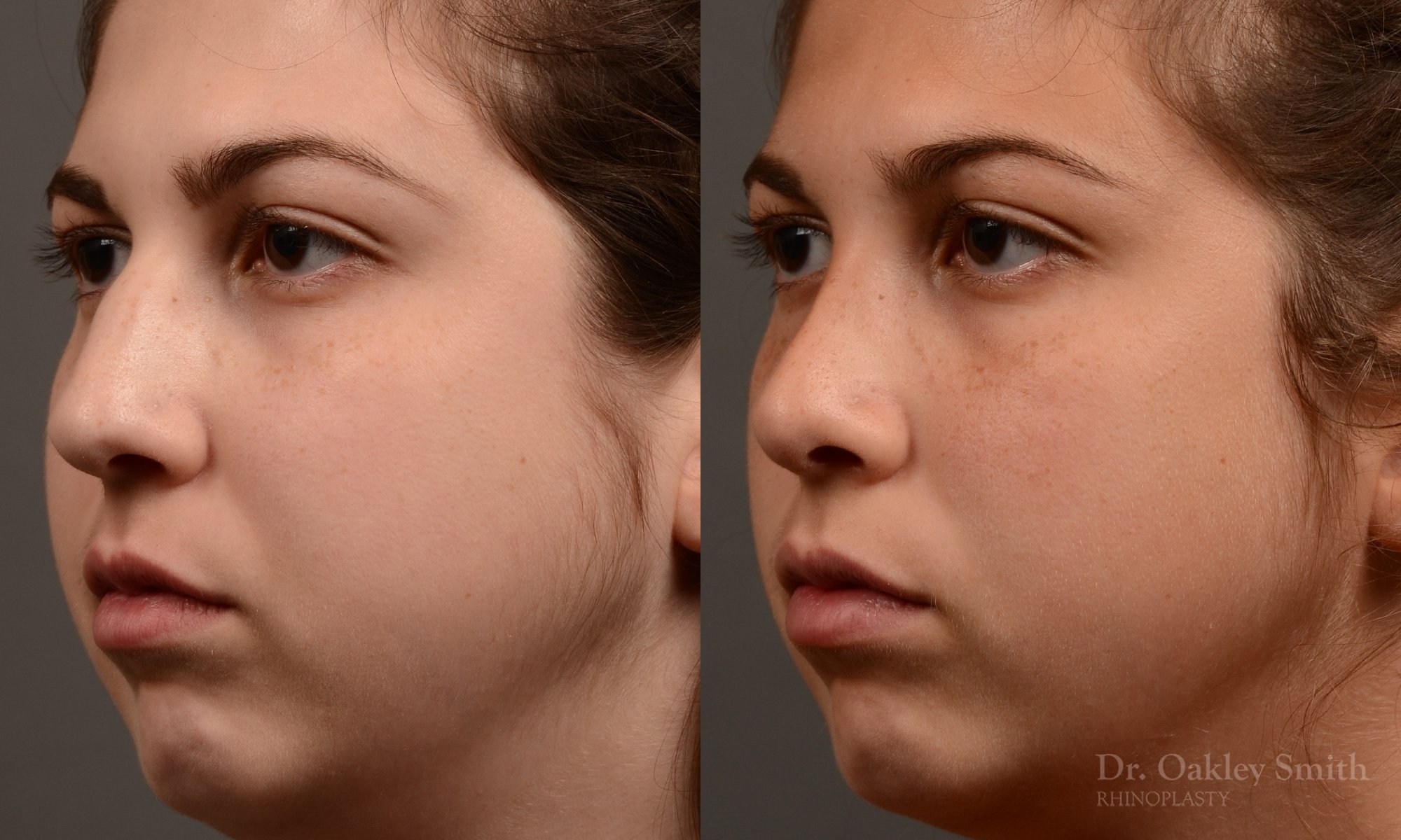 371D-rhinoplasty-dr-oakley-smith-toronto-nose-job.jpg