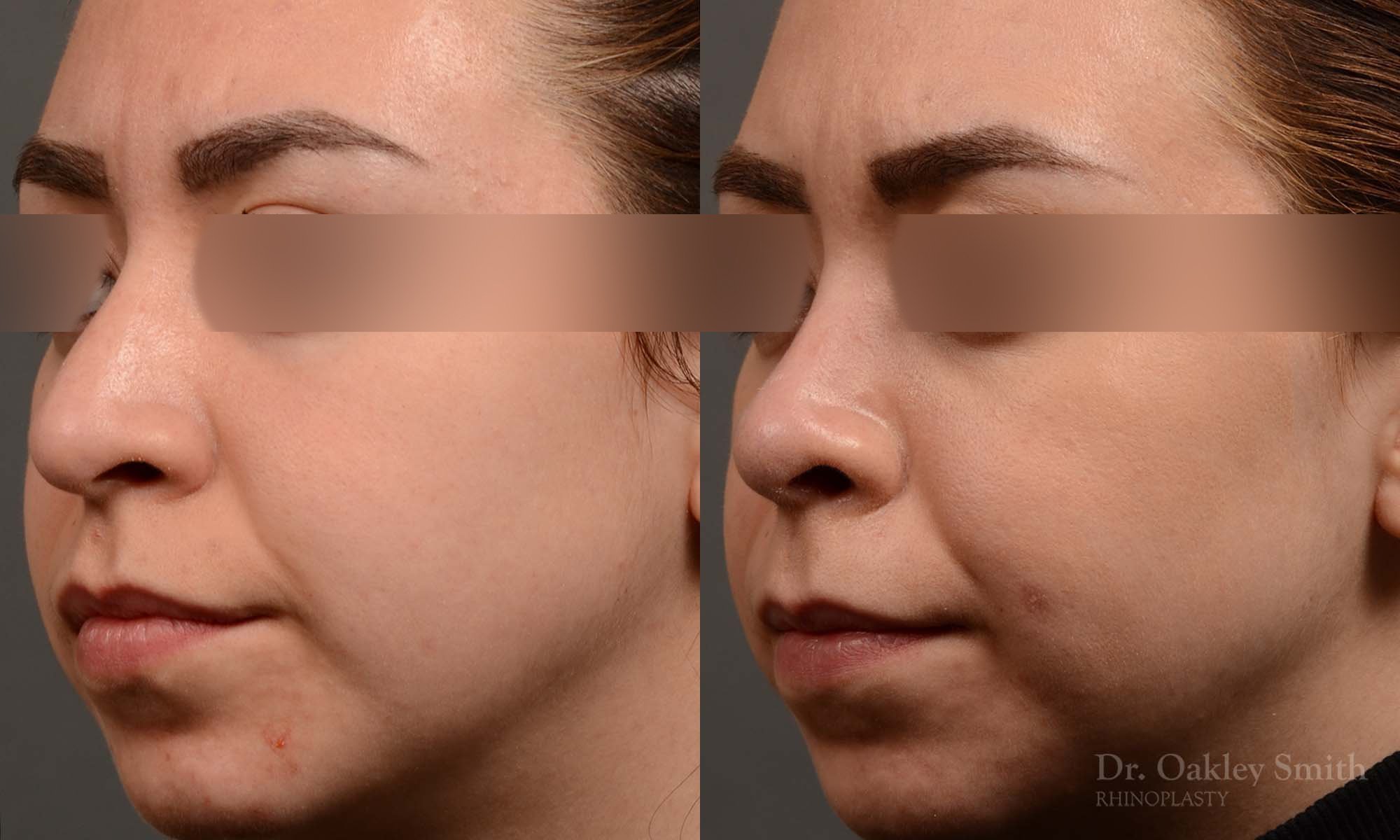 342D-rhinoplasty-dr-oakley-smith-toronto-nose-job.jpg