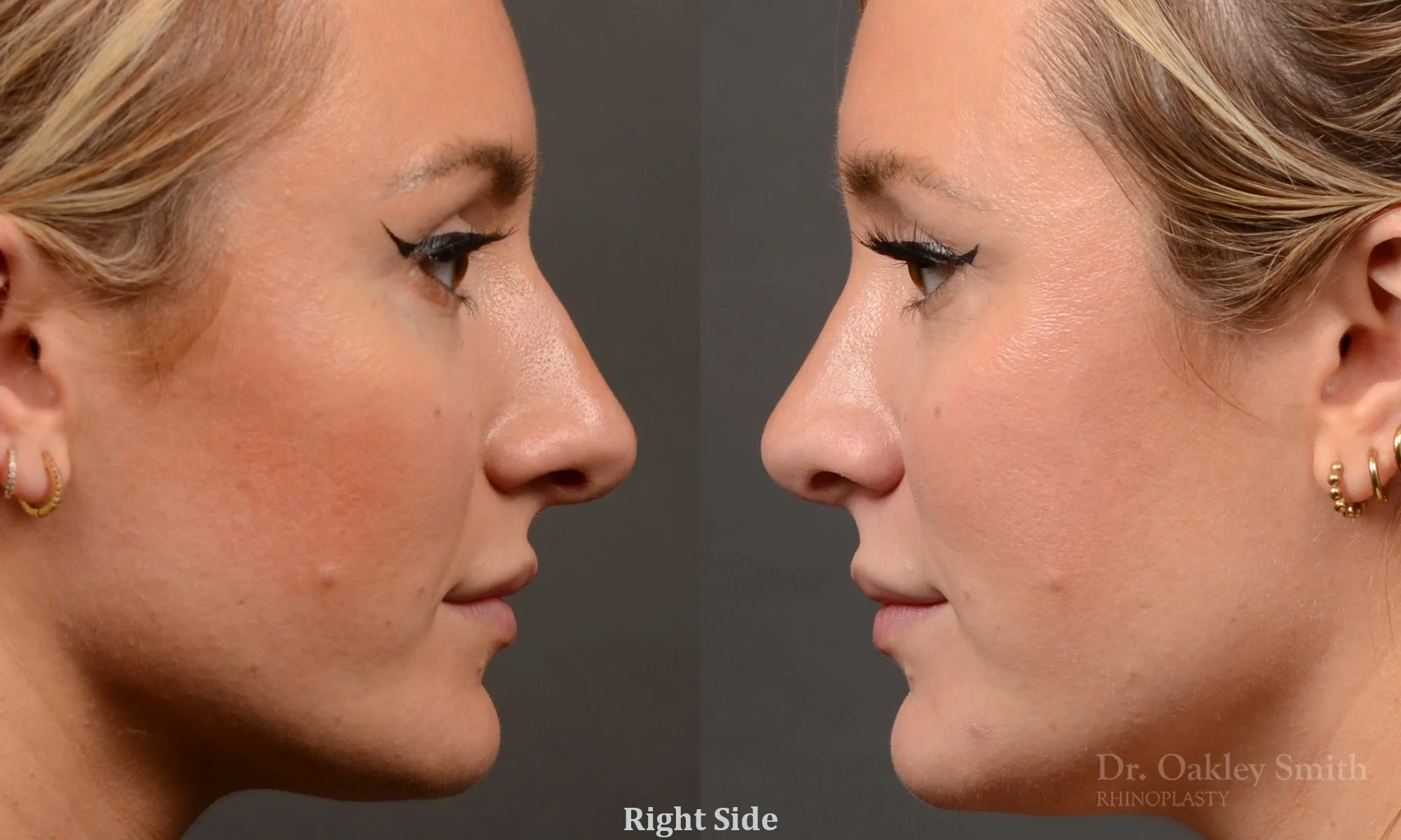 550: Female, Primary Rhinoplasty,  Dorsal Bump, Tip Rotation