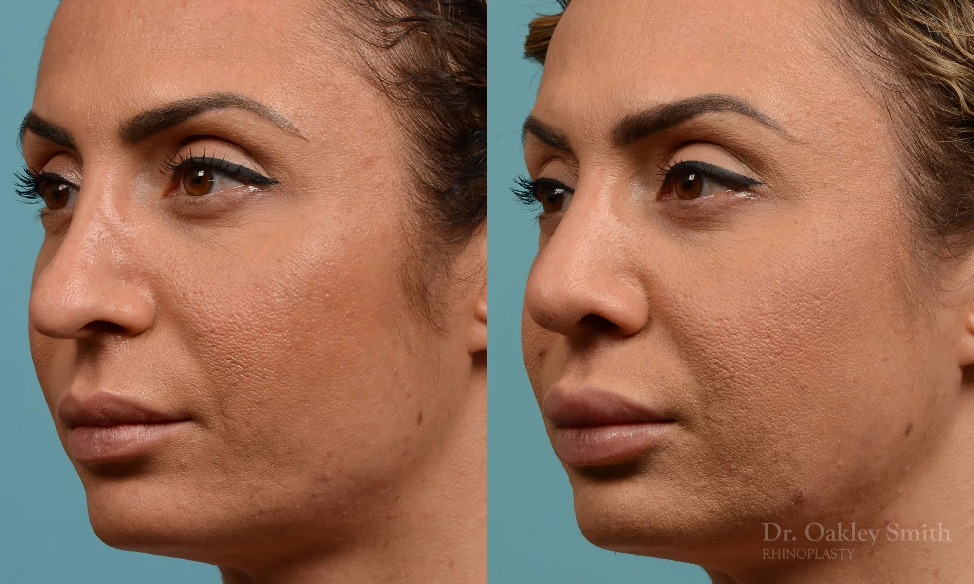 338D-rhinoplasty-dr-oakley-smith-toronto-nose-job.jpg