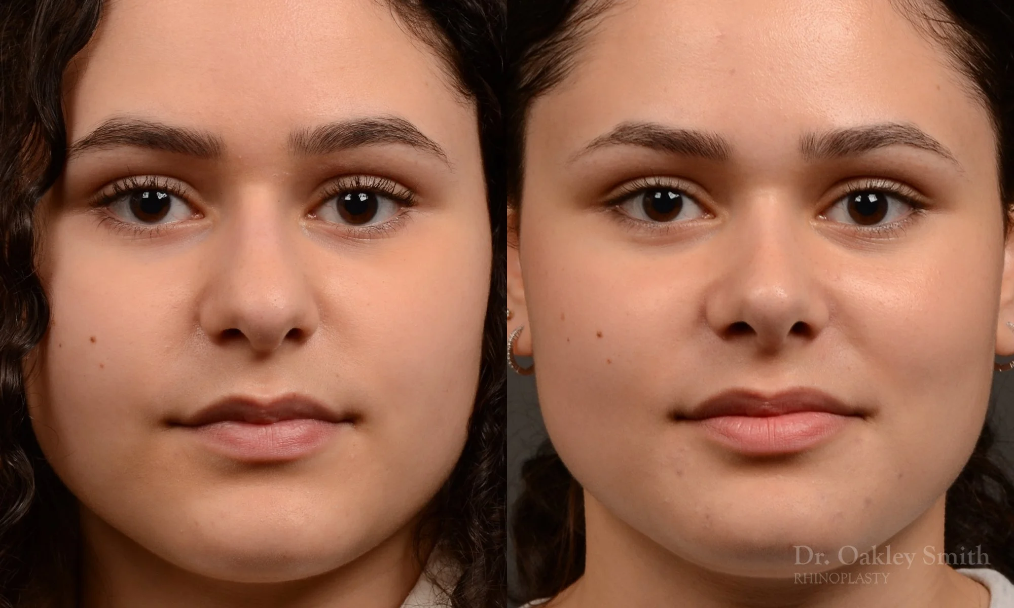 Female, Primary Rhinoplasty, Normal Skin, Bridge Work, Tip Work
