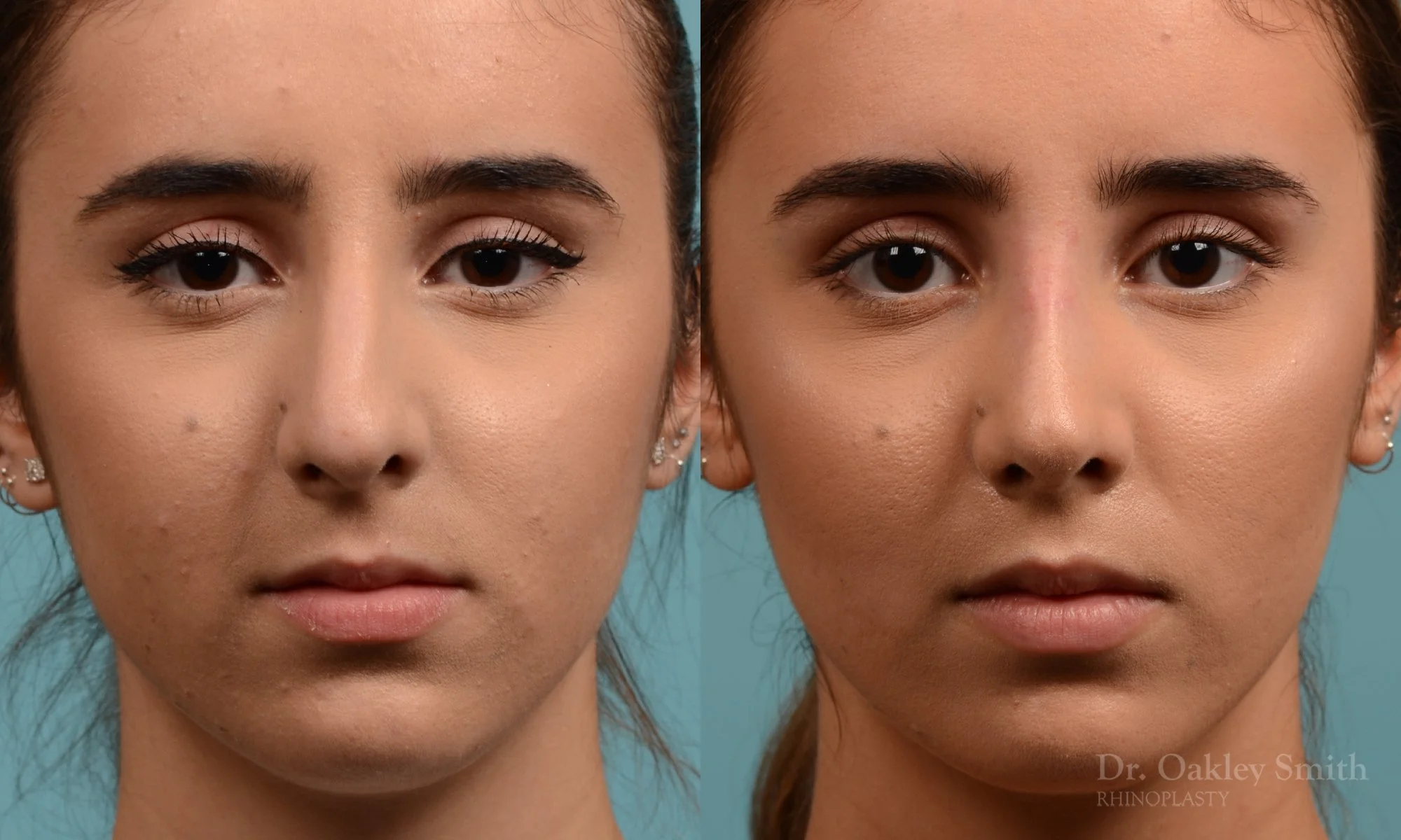 301A-rhinoplasty-dr-oakley-smith-toronto-nose-job (1).jpg