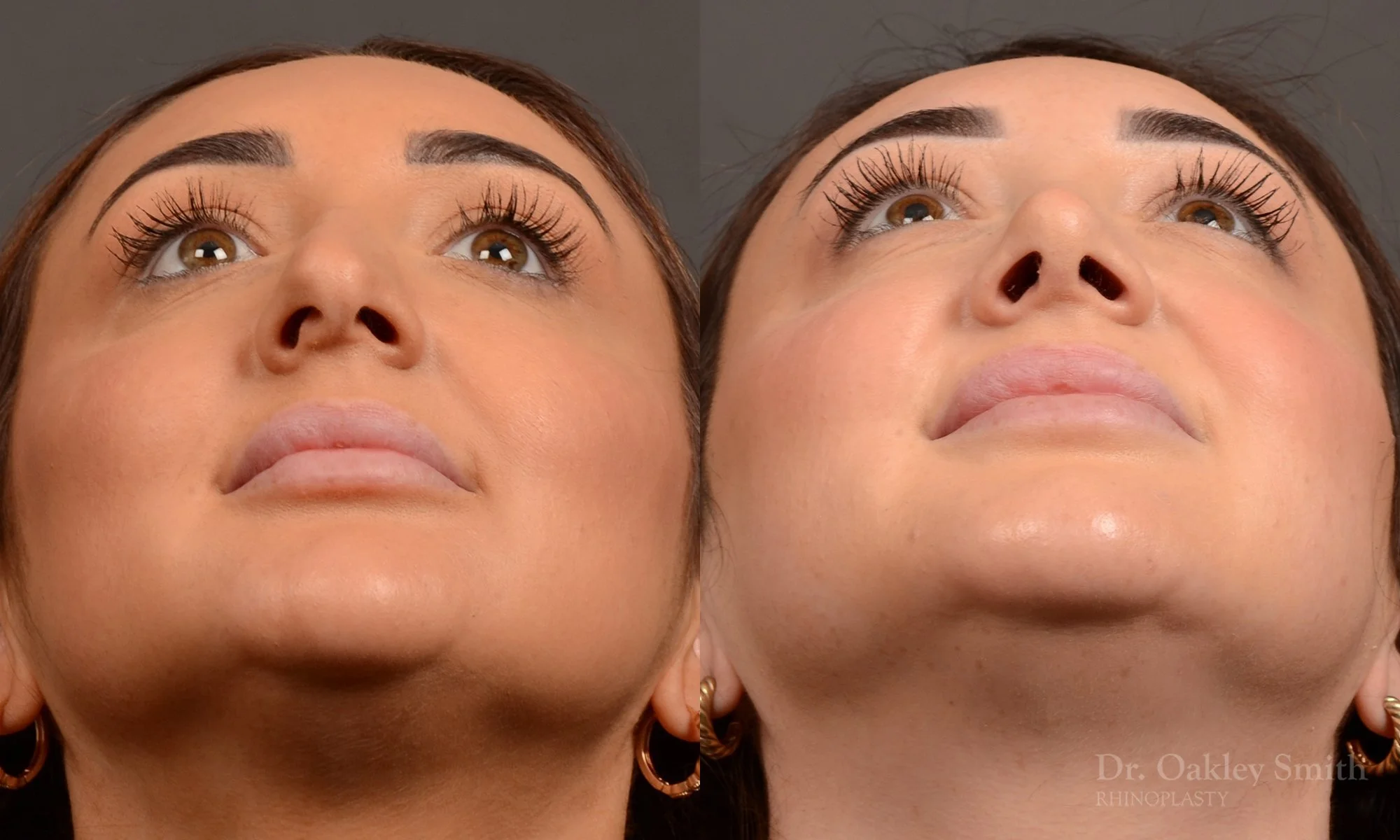 502F-rhinoplasty-dr-oakley-smith-toronto-top-surgeon-nose-job.jpg