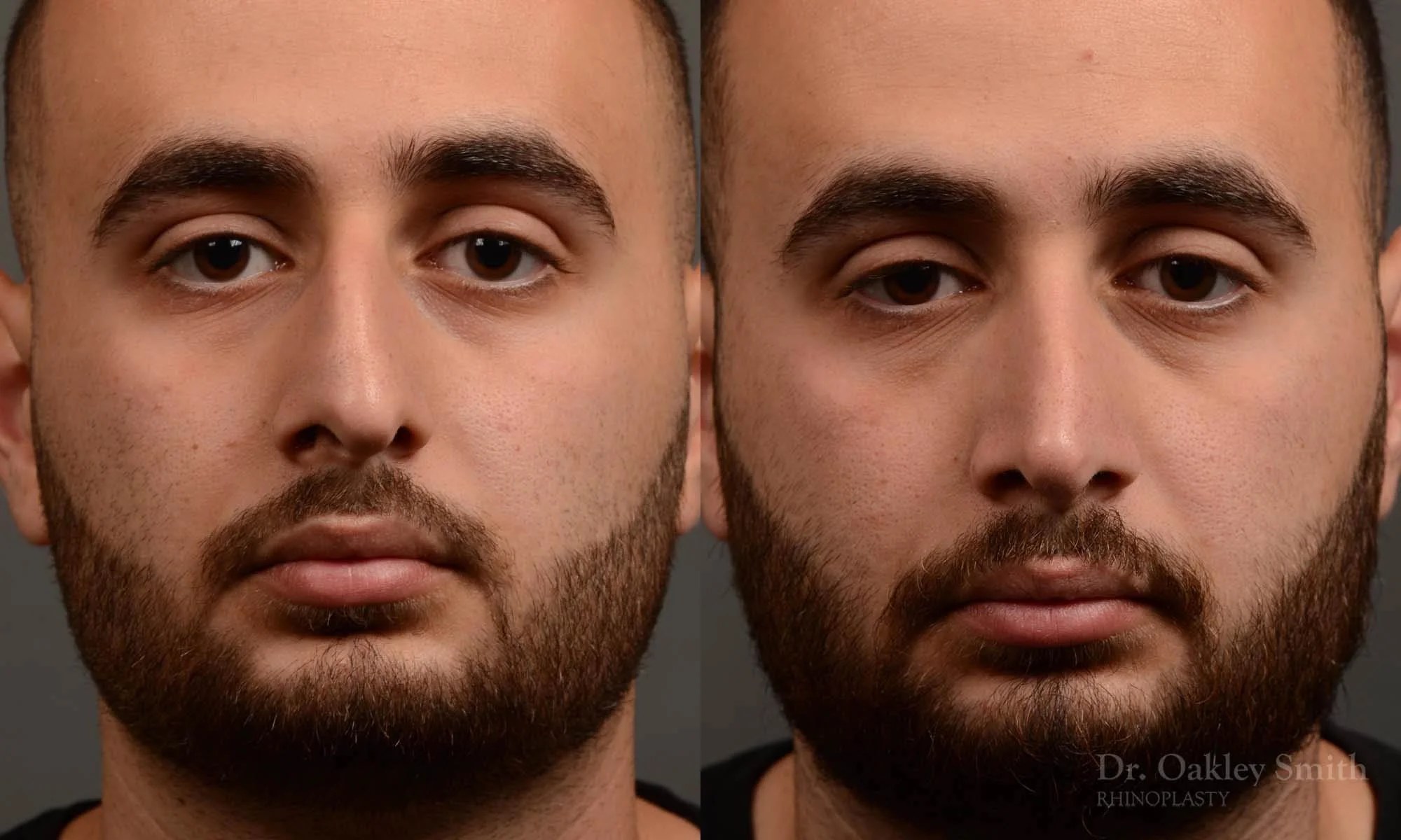 391A-rhinoplasty-dr-oakley-smith-toronto-nose-job.jpg