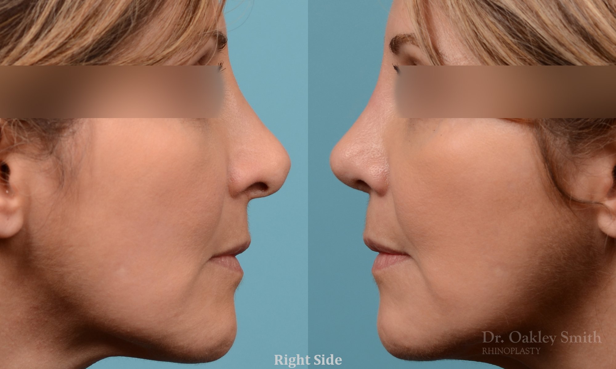 244: Female, Revision Rhinoplasty, Tip Reconstruction