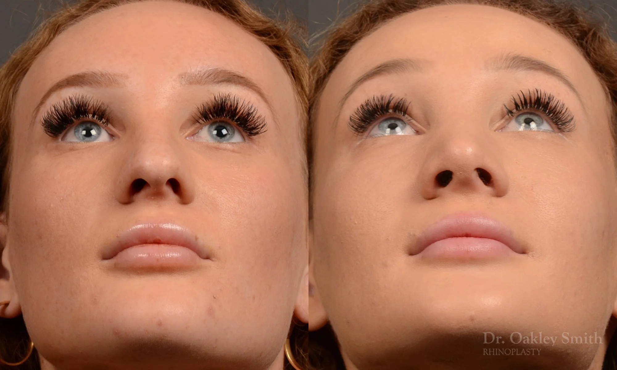 491F-rhinoplasty-dr-oakley-smith-toronto-top-surgeon-nose-job.jpg