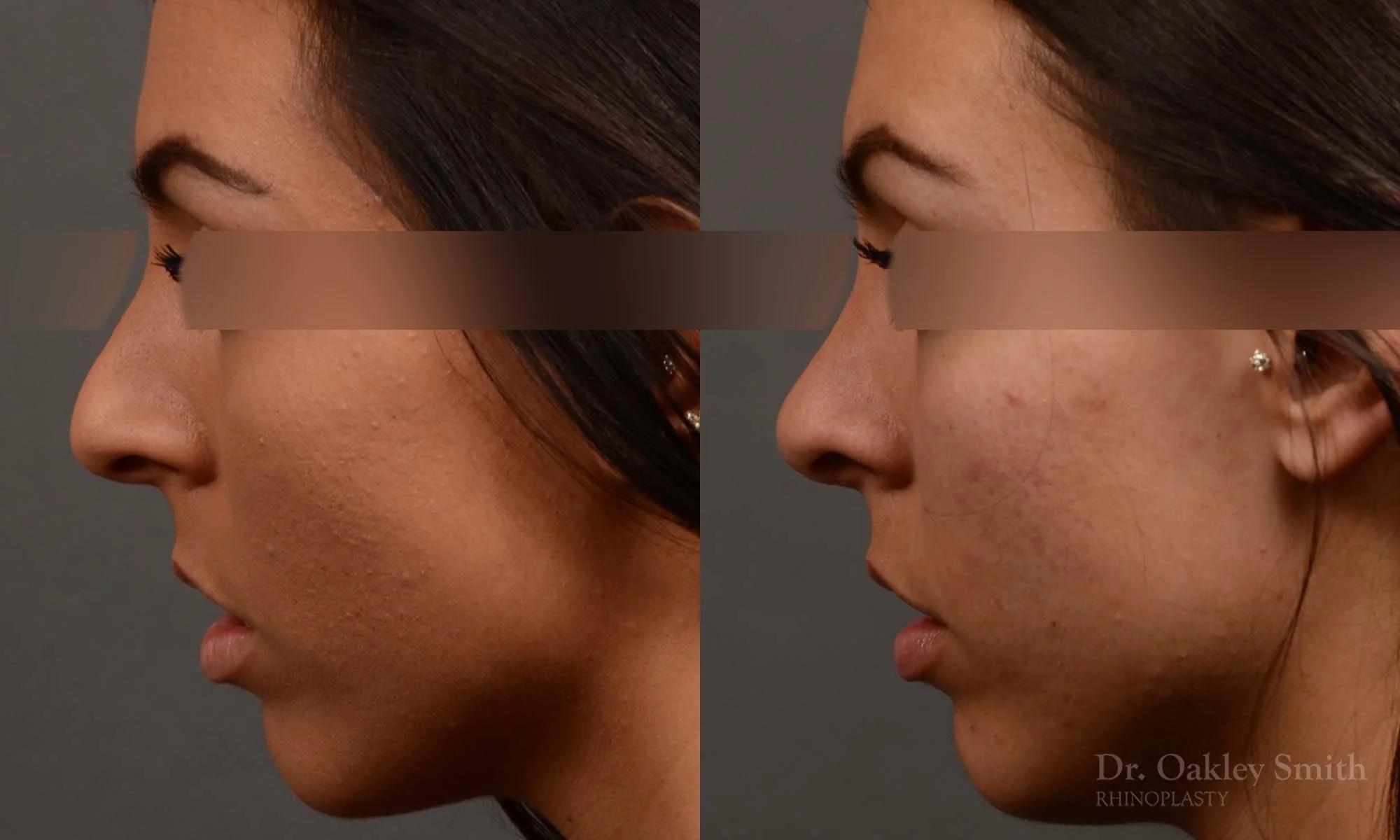 320E-rhinoplasty-dr-oakley-smith-toronto-nose-job.jpg