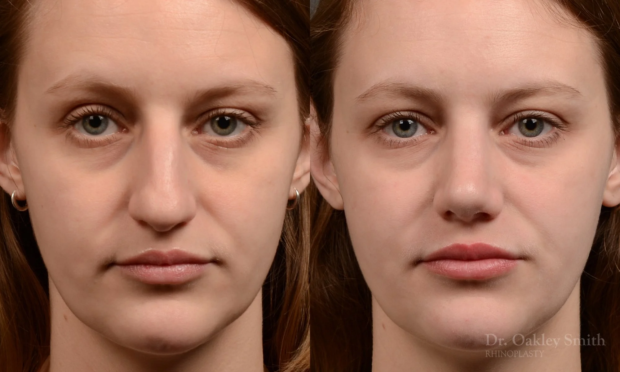 539A-rhinoplasty-dr-oakley-smith-toronto-nose-job.jpg