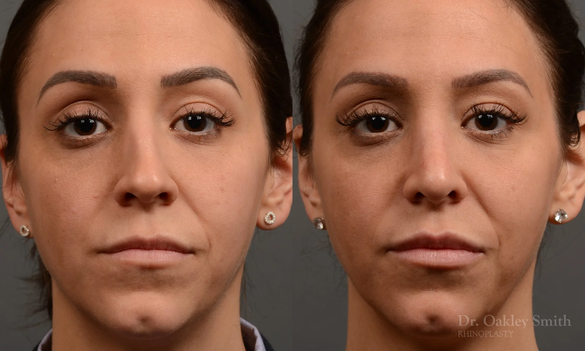 353A-rhinoplasty-dr-oakley-smith-toronto-nose-job.jpg