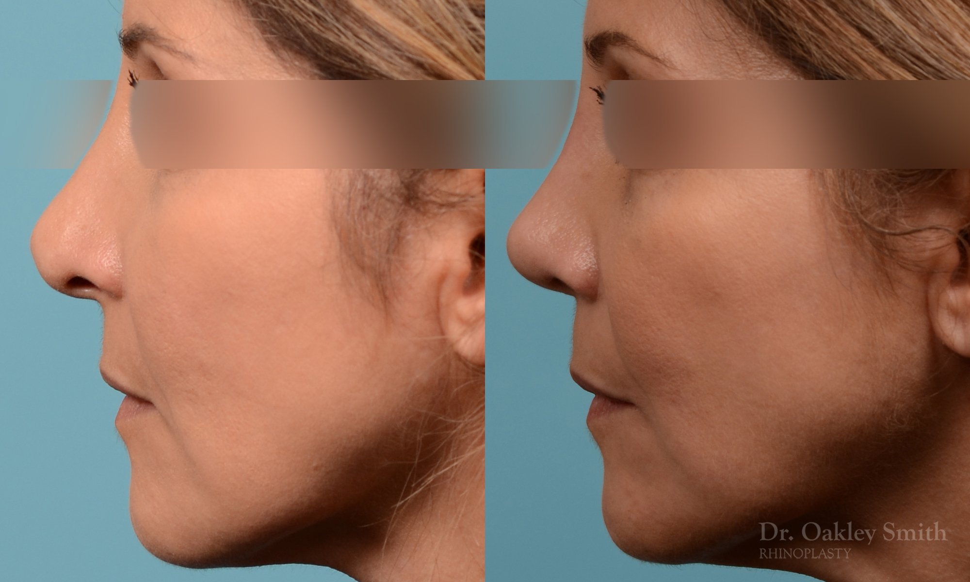244E-rhinoplasty-dr-oakley-smith-septum.jpg