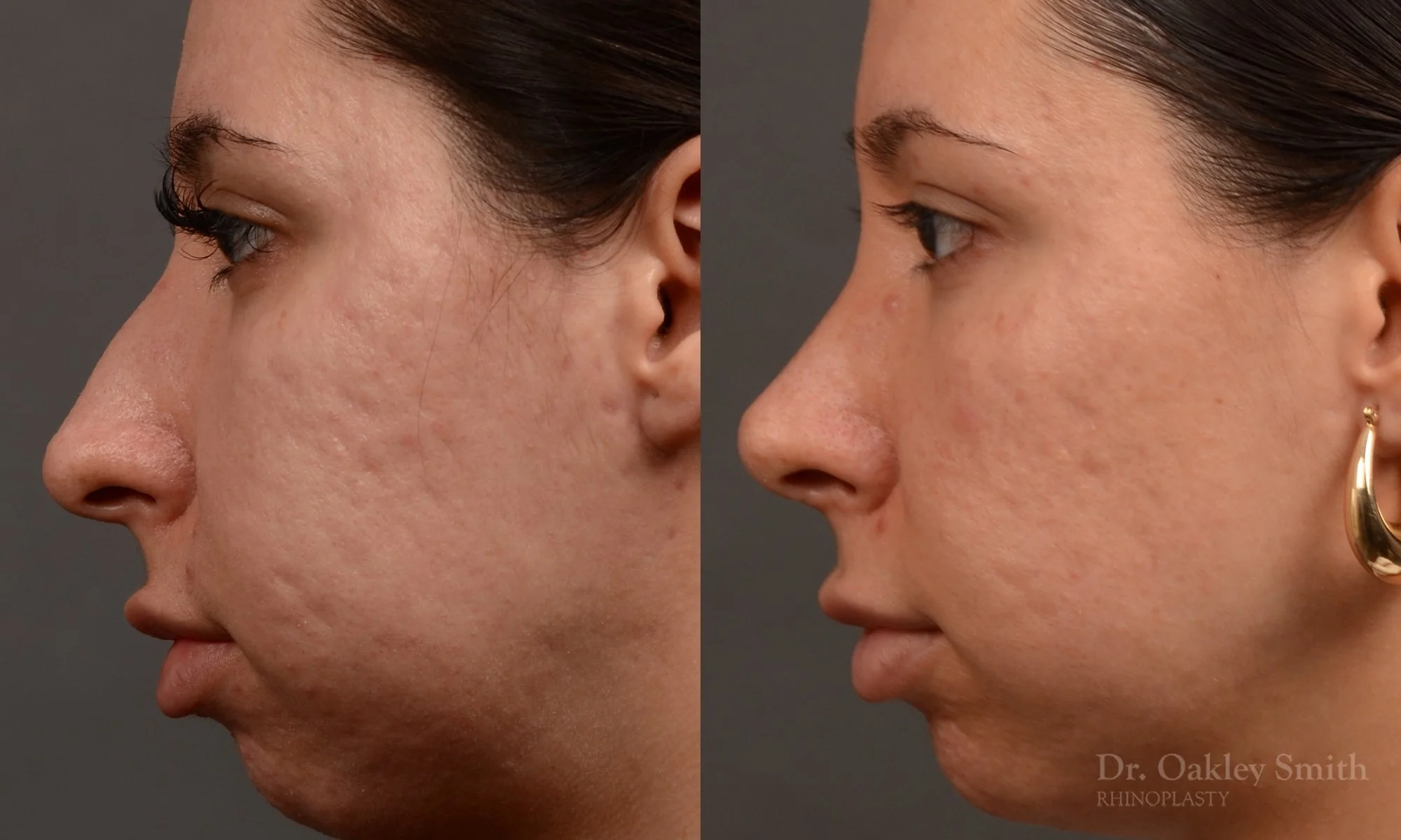 486E-rhinoplasty-dr-oakley-smith-toronto-top-surgeon-nose-job.jpg
