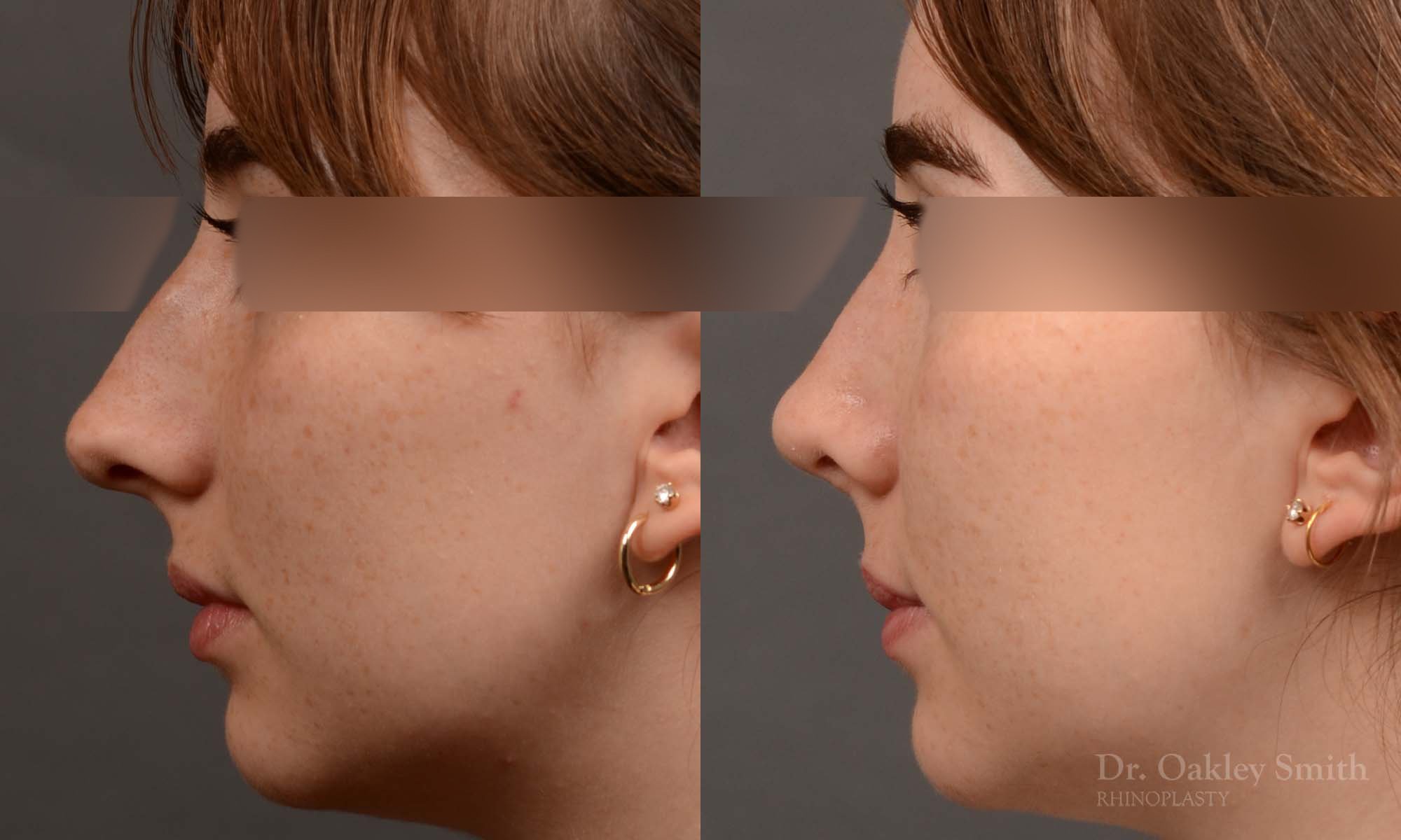 551E-rhinoplasty-nose-job-toronto-nose-surgeon-dr-oakley-smith.jpg