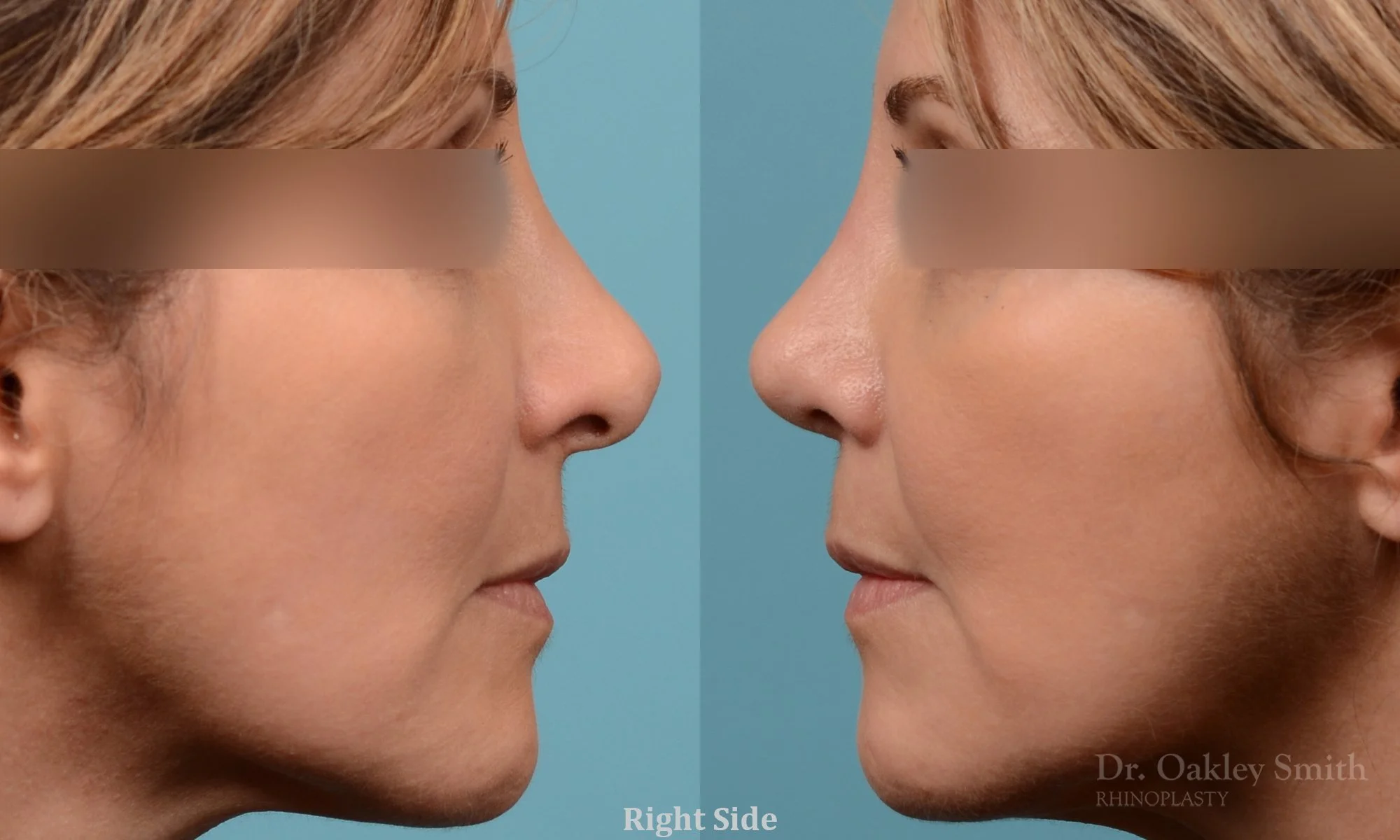 244: Female Rhinoplasty, Twisted Tip Narrowing Refinement