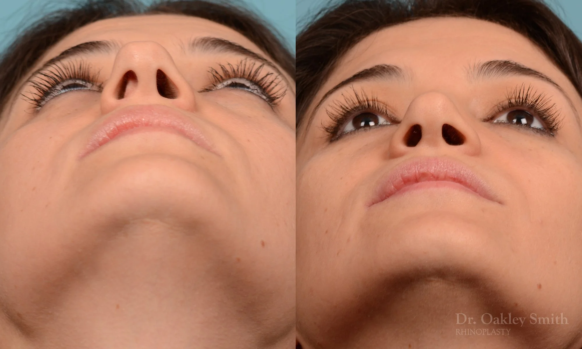 234F-nose-job-nose-reduction-rhinoplasty-pointy-nose-curved-nose-dr-oakley-smith-toronto.jpg