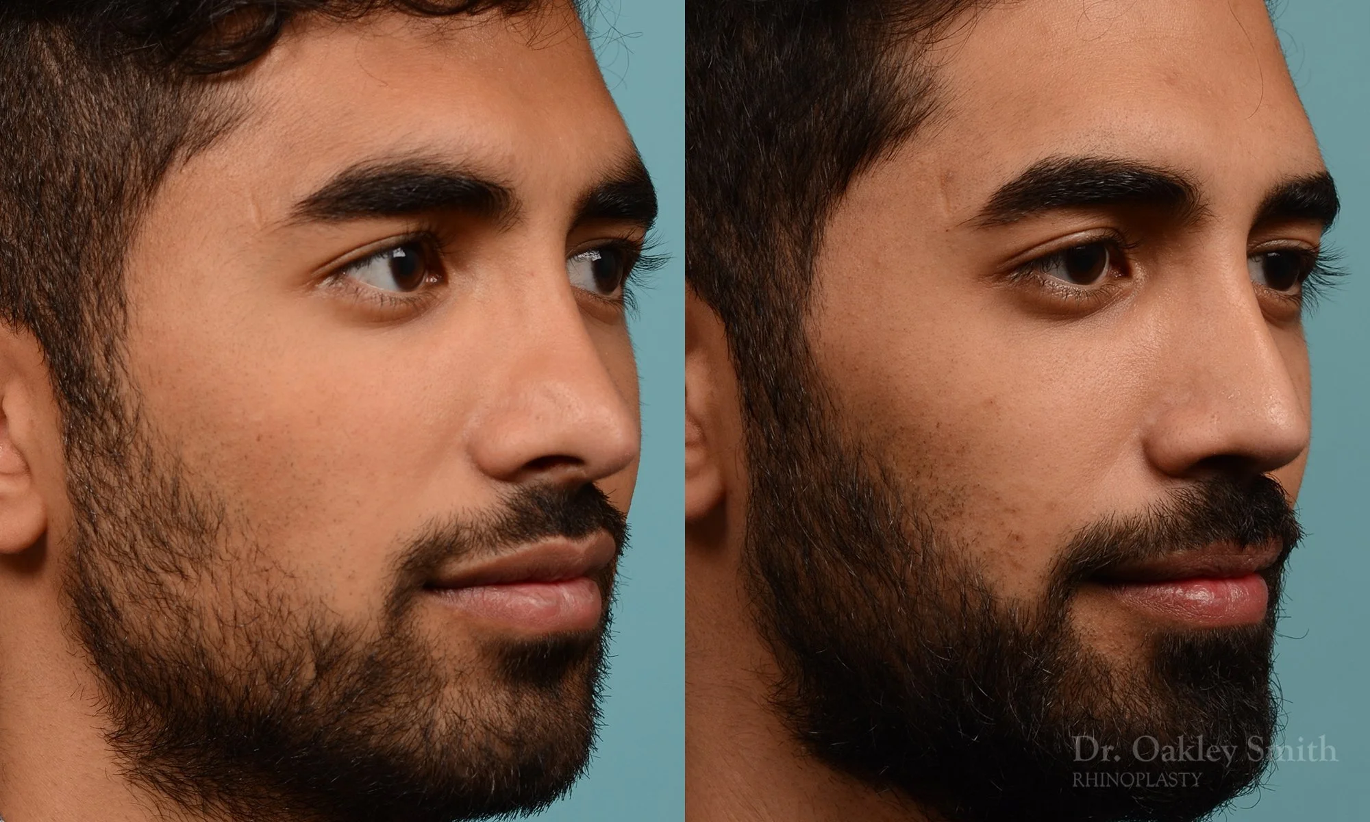 201.1B-rhinoplasty-dr-oakley-smith-toronto-nose-job.jpg