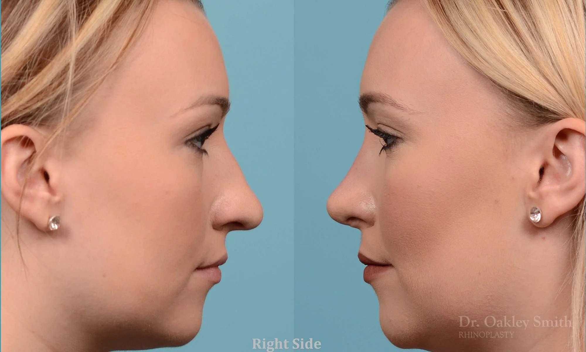 202: Female Rhinoplasty, Dorsal Hump, Tip Lift Narrowing Refinement