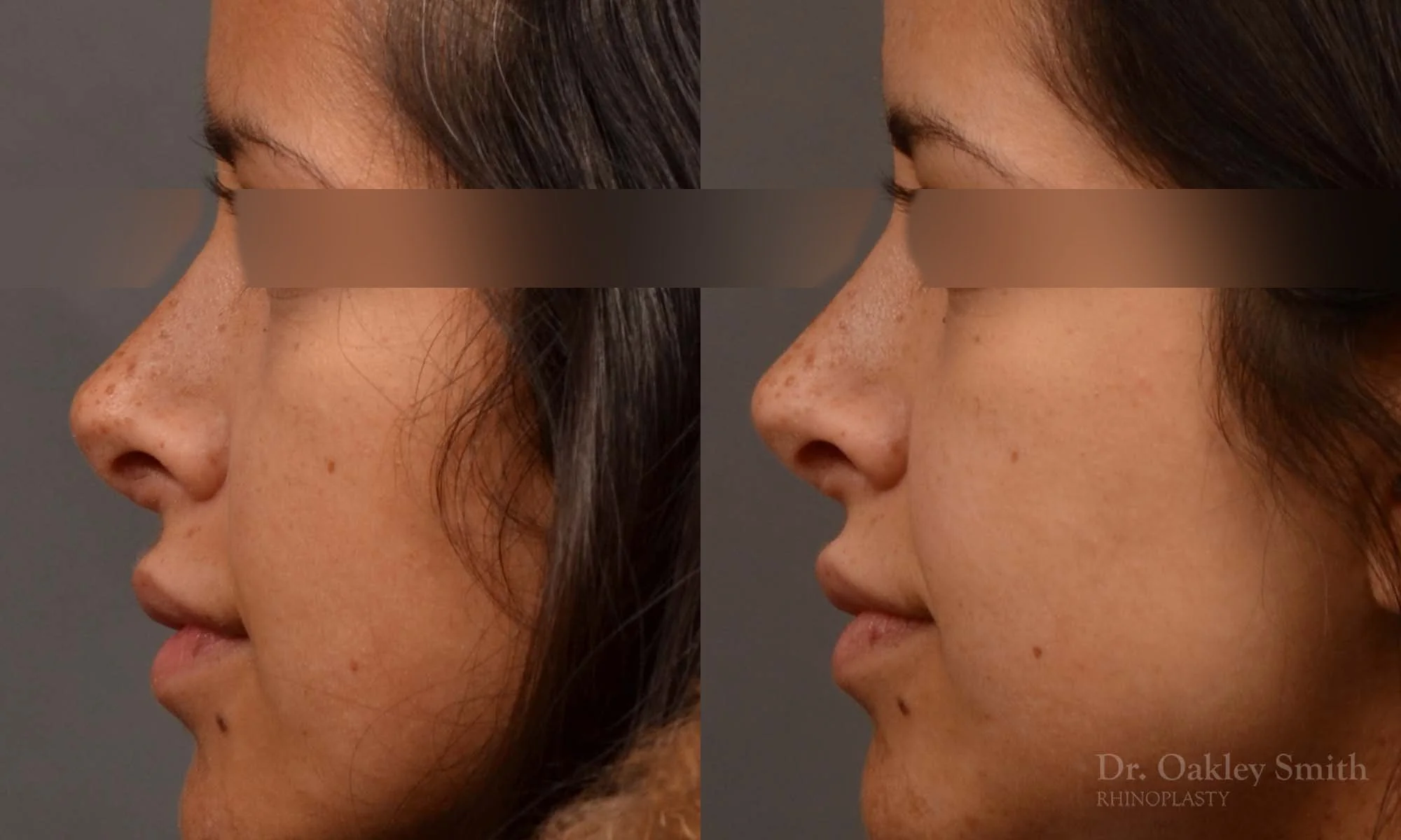 492E-rhinoplasty-dr-oakley-smith-toronto-top-surgeon-nose-job.jpg