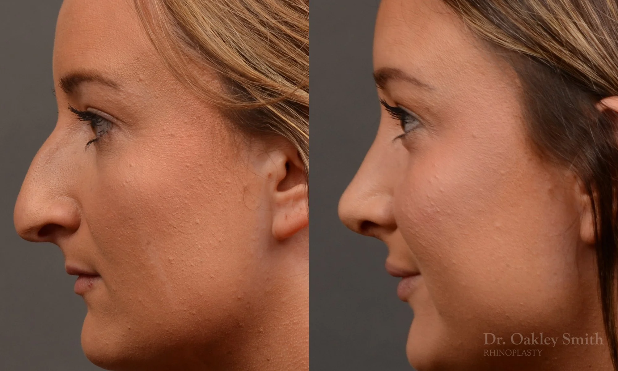 478E-rhinoplasty-dr-oakley-smith-toronto-top-surgeon-nose-job.jpg