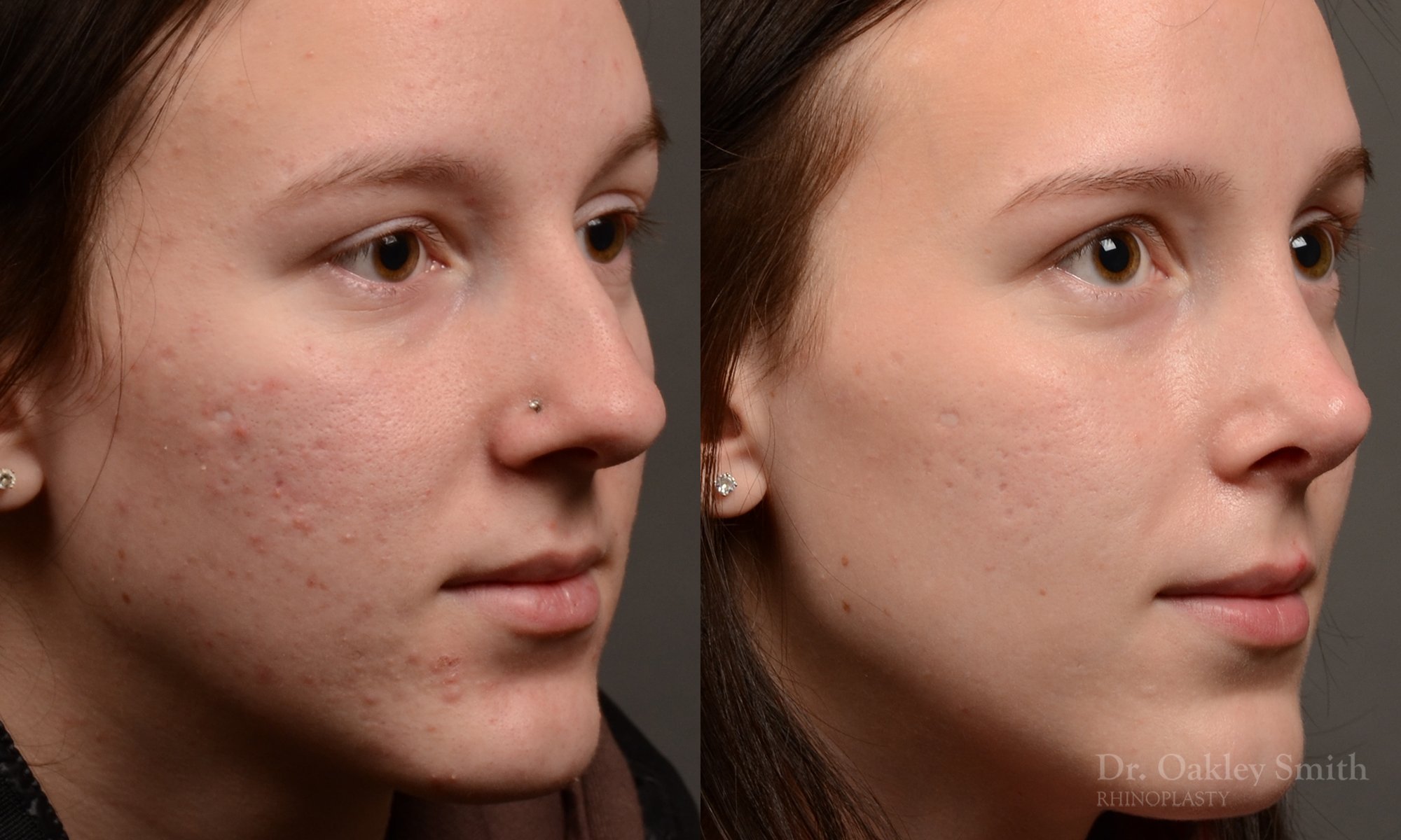 511B-rhinoplasty-dr-oakley-smith-toronto-top-surgeon-nose-job.jpg