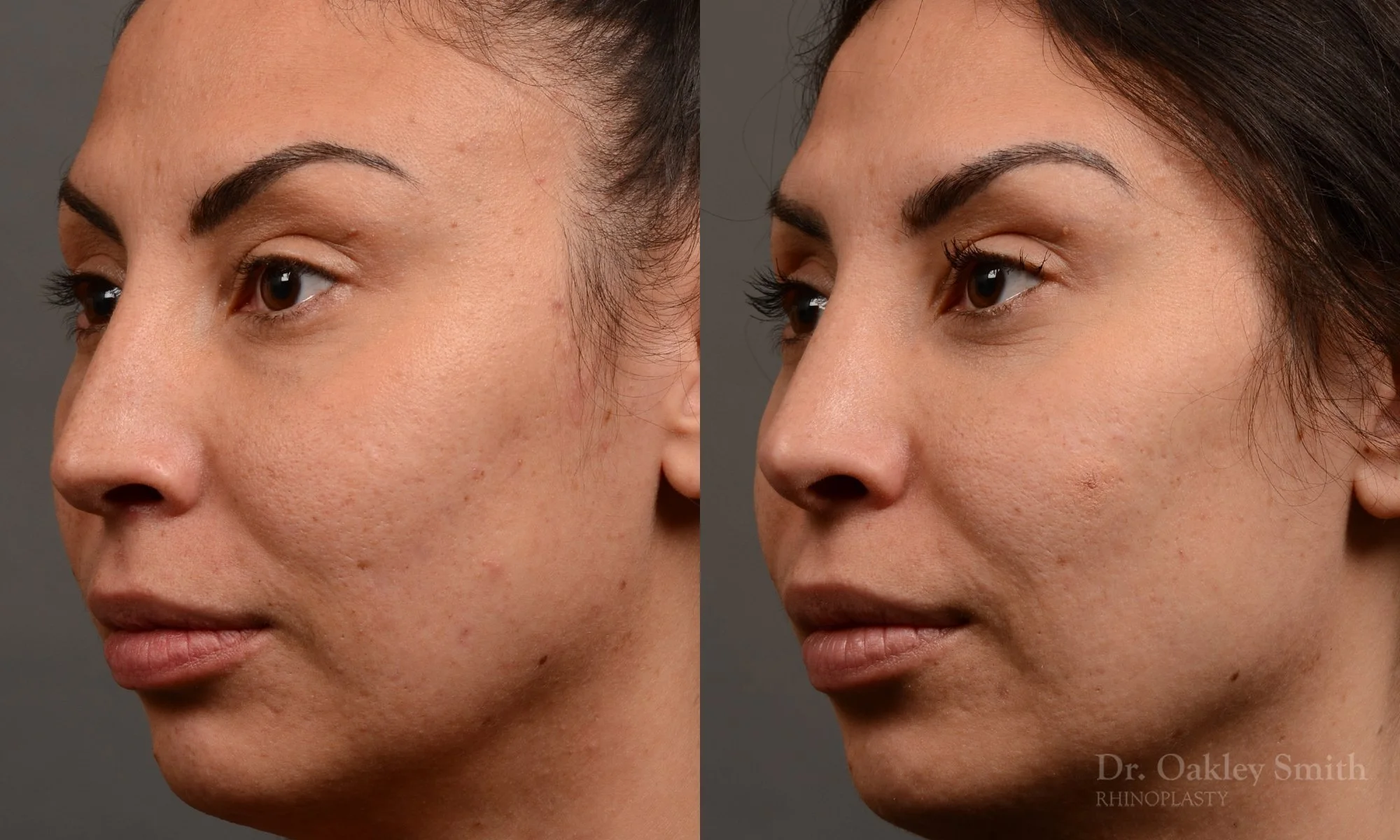 279.1D-rhinoplasty-dr-oakley-smith-toronto-nose-job.jpg