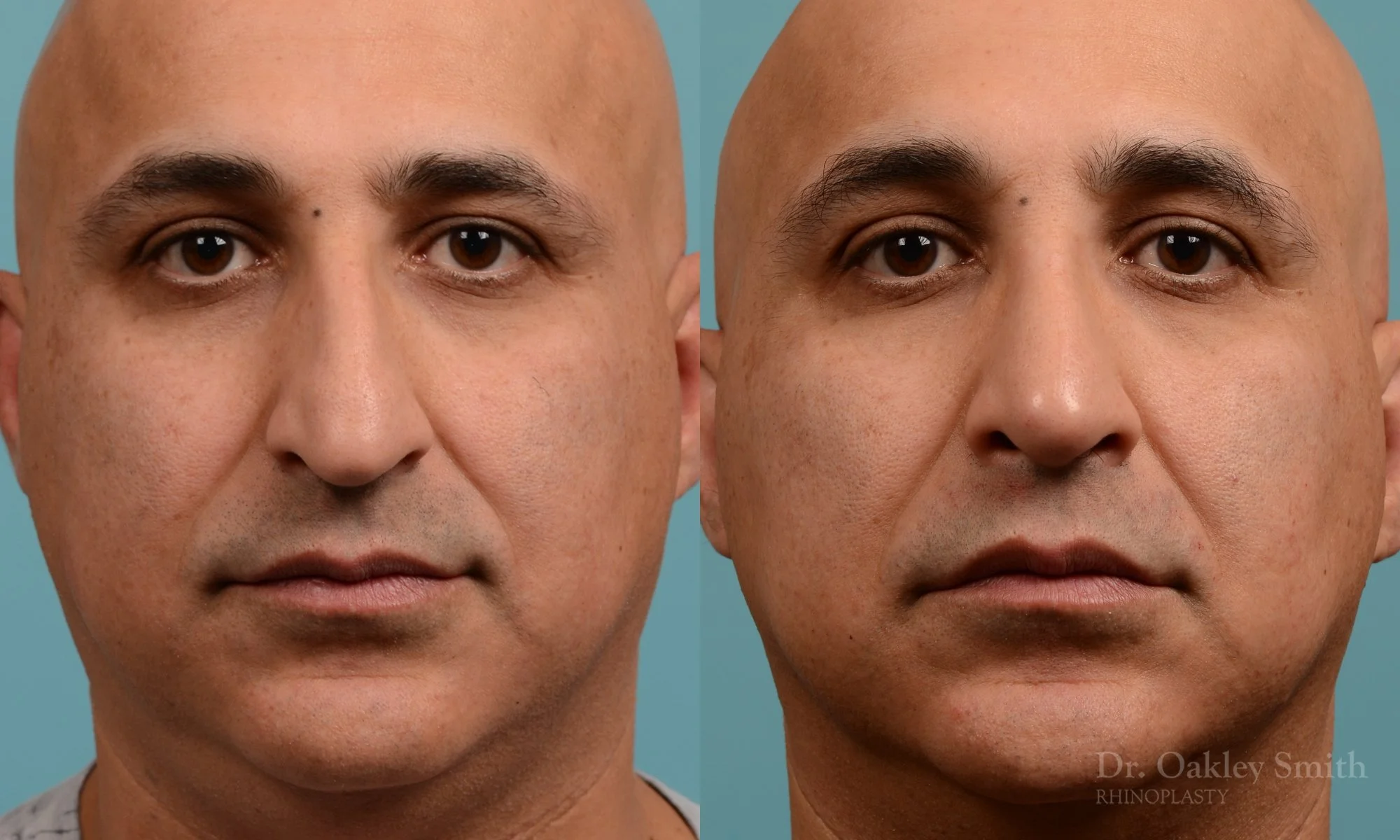 349.1A-rhinoplasty-dr-oakley-smith-toronto-nose-job.jpg