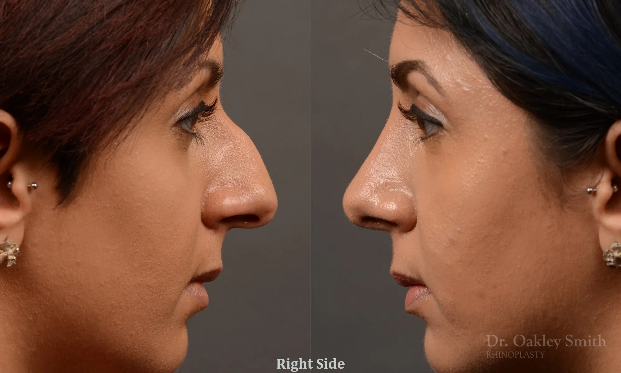 376.1C-rhinoplasty-dr-oakley-smith-toronto-nose-job.jpg
