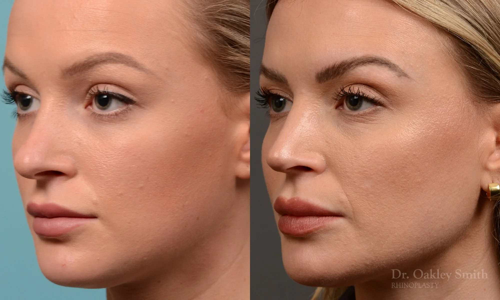 538D-rhinoplasty-dr-oakley-smith-toronto-nose-job.jpg