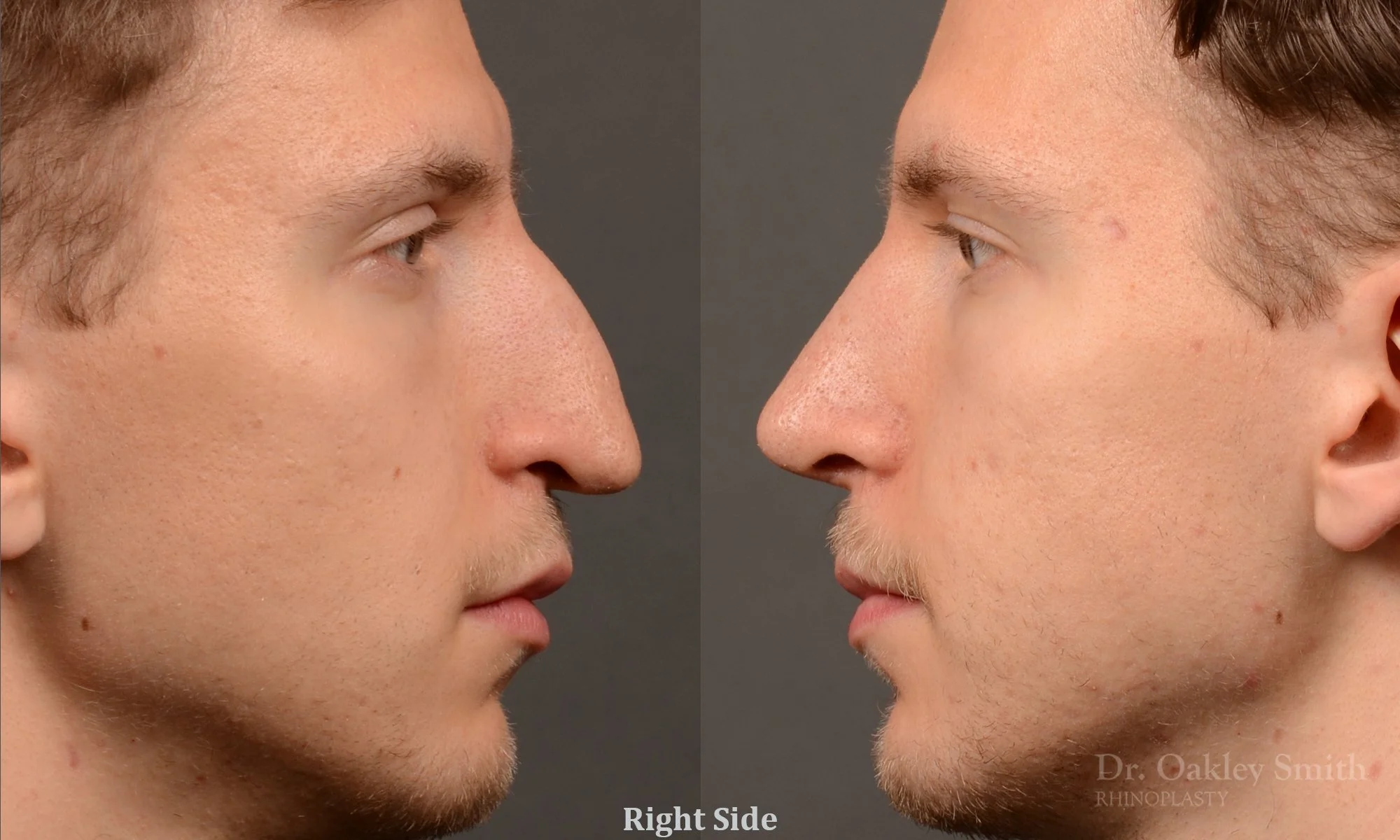498C-rhinoplasty-dr-oakley-smith-toronto-top-surgeon-nose-job.jpg