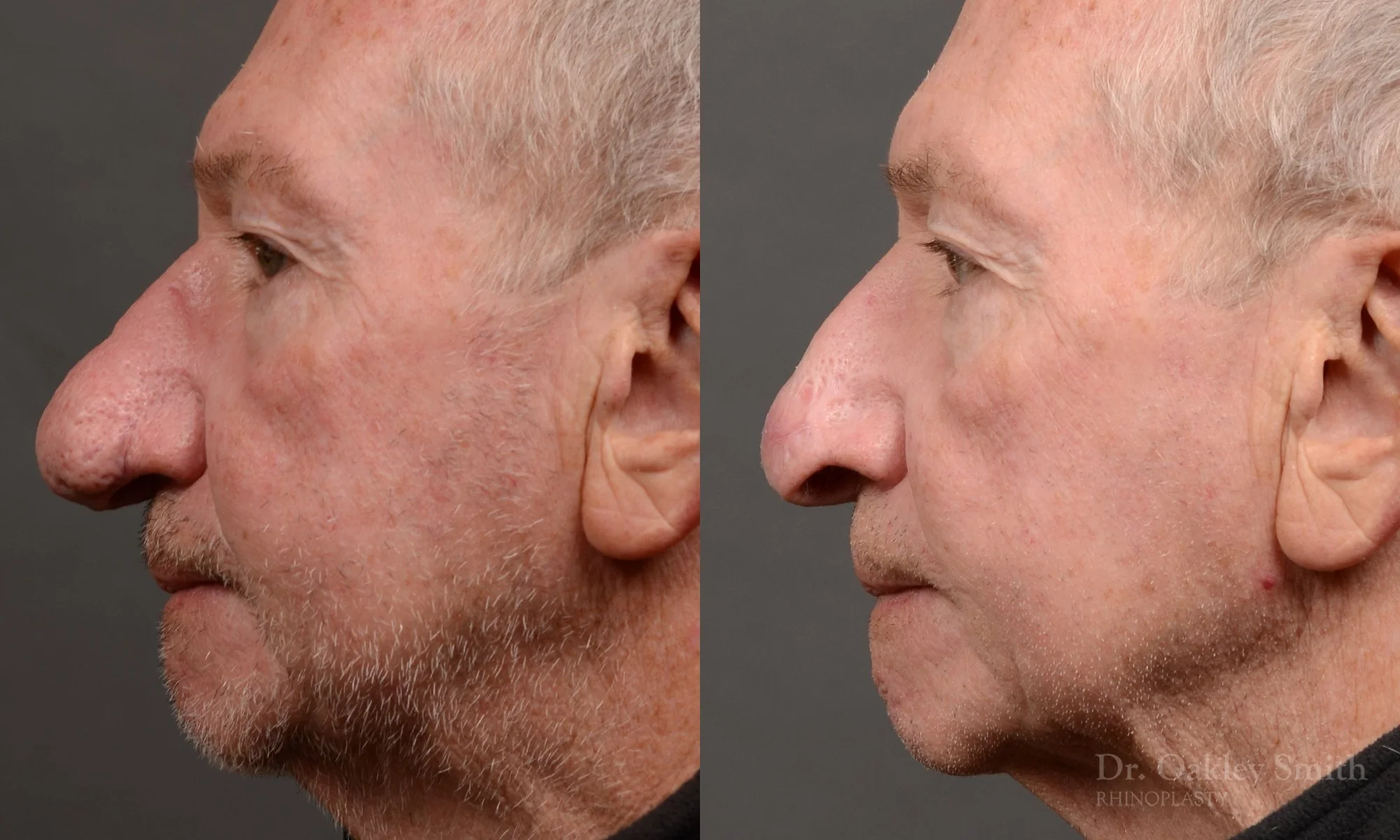 Case 548 dr oakley smith, male rhinophyma, 12 months after surgery, left profile.jpg