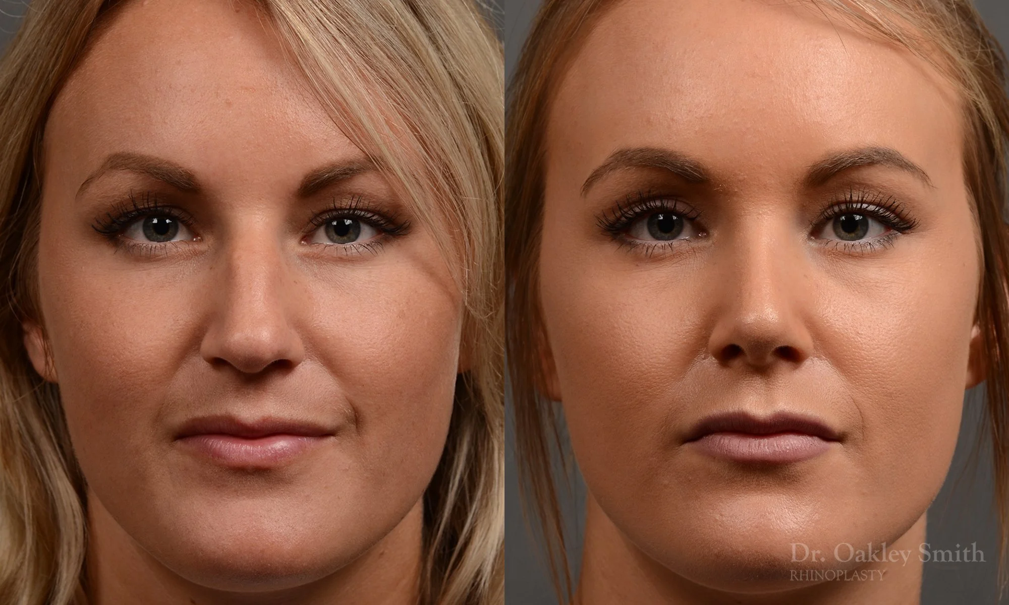 336A-rhinoplasty-dr-oakley-smith-toronto-nose-job.jpg