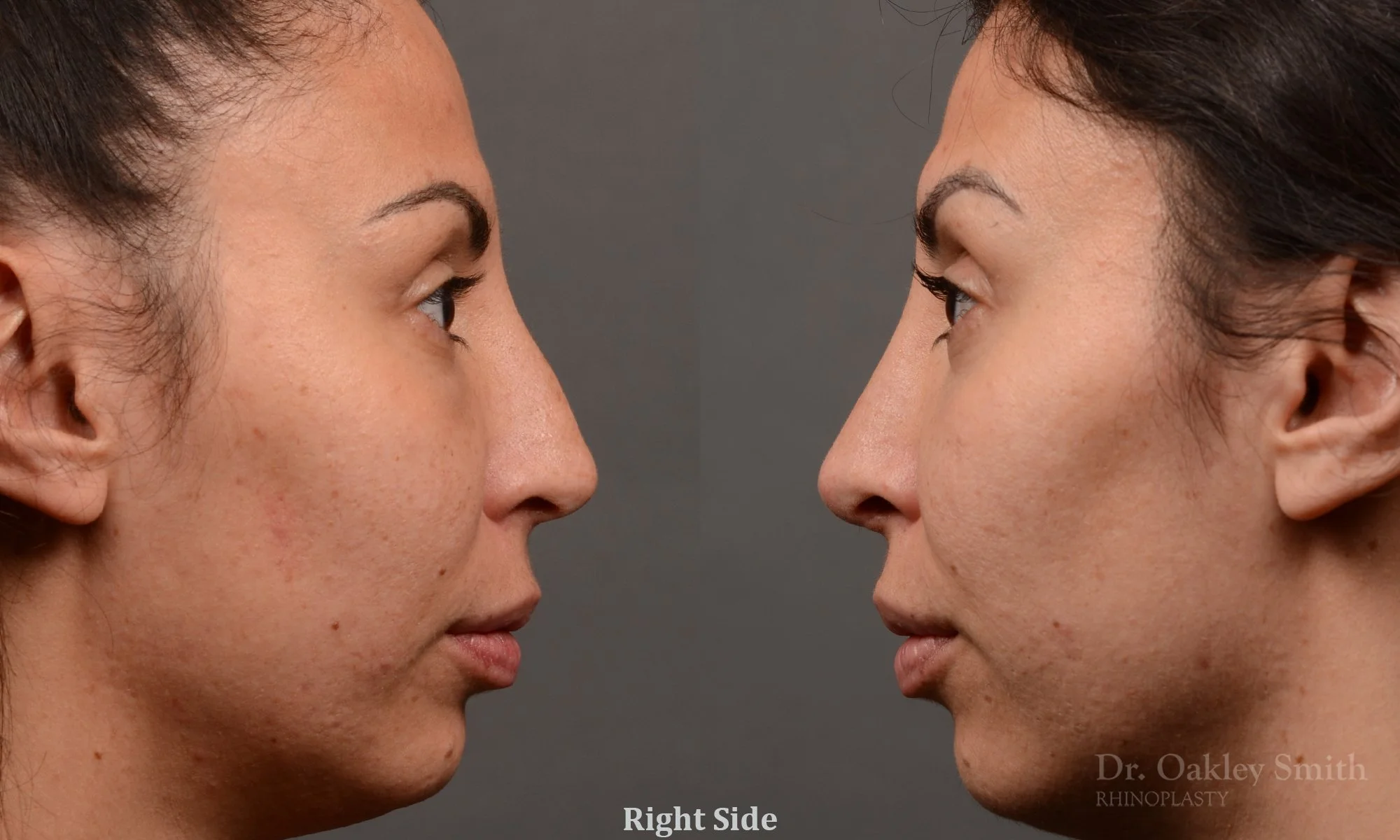 279.1C-rhinoplasty-dr-oakley-smith-toronto-nose-job.jpg