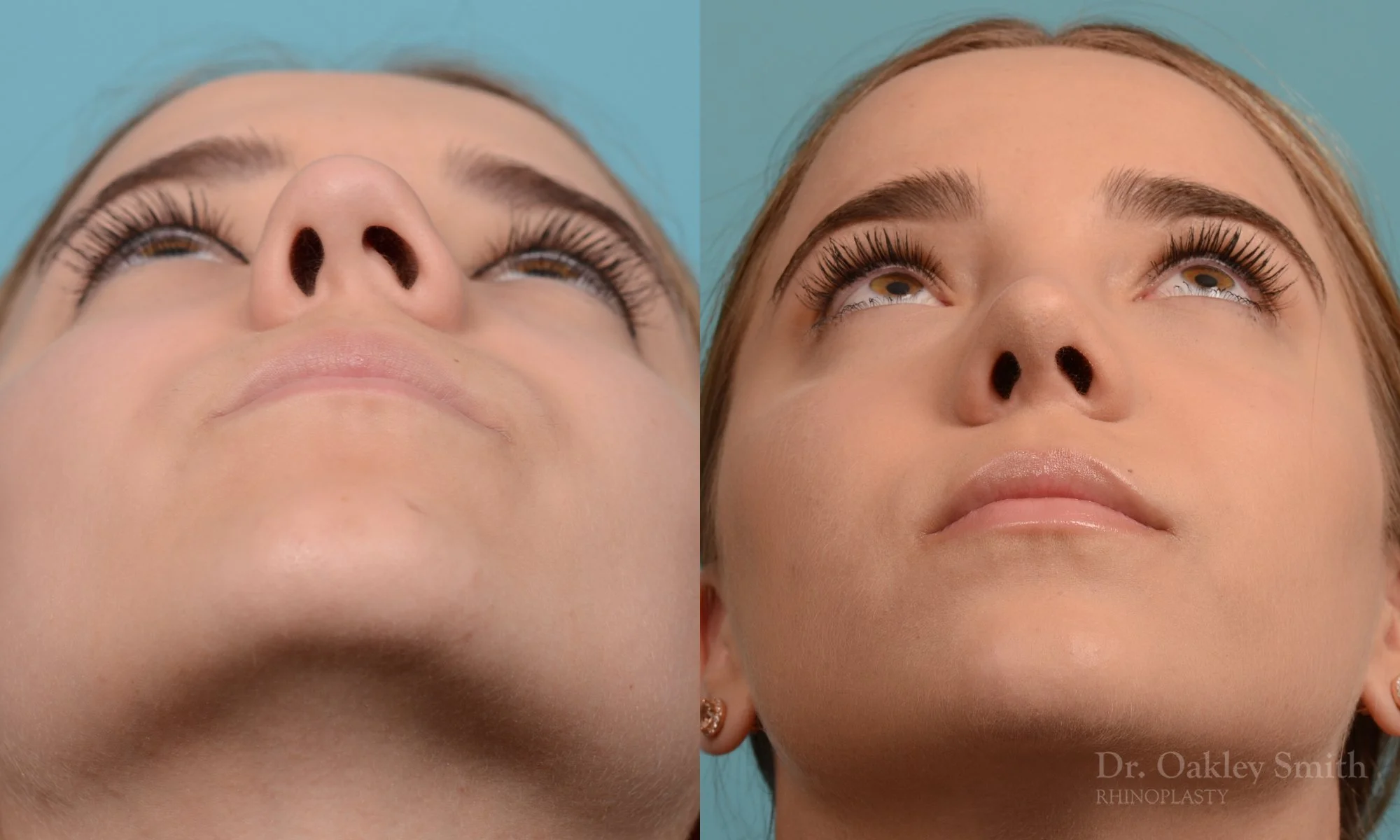 355F-rhinoplasty-dr-oakley-smith-toronto-nose-job.jpg