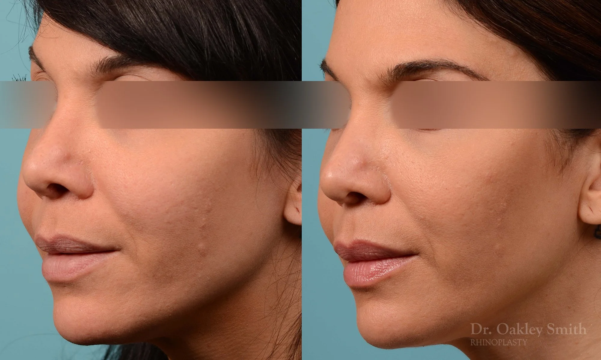 219D-rhinoplasty-toronto-dr-oakley-smith-curved-bridge-raised-tip-rotation-big-nose-nose-job-1 (1).jpg