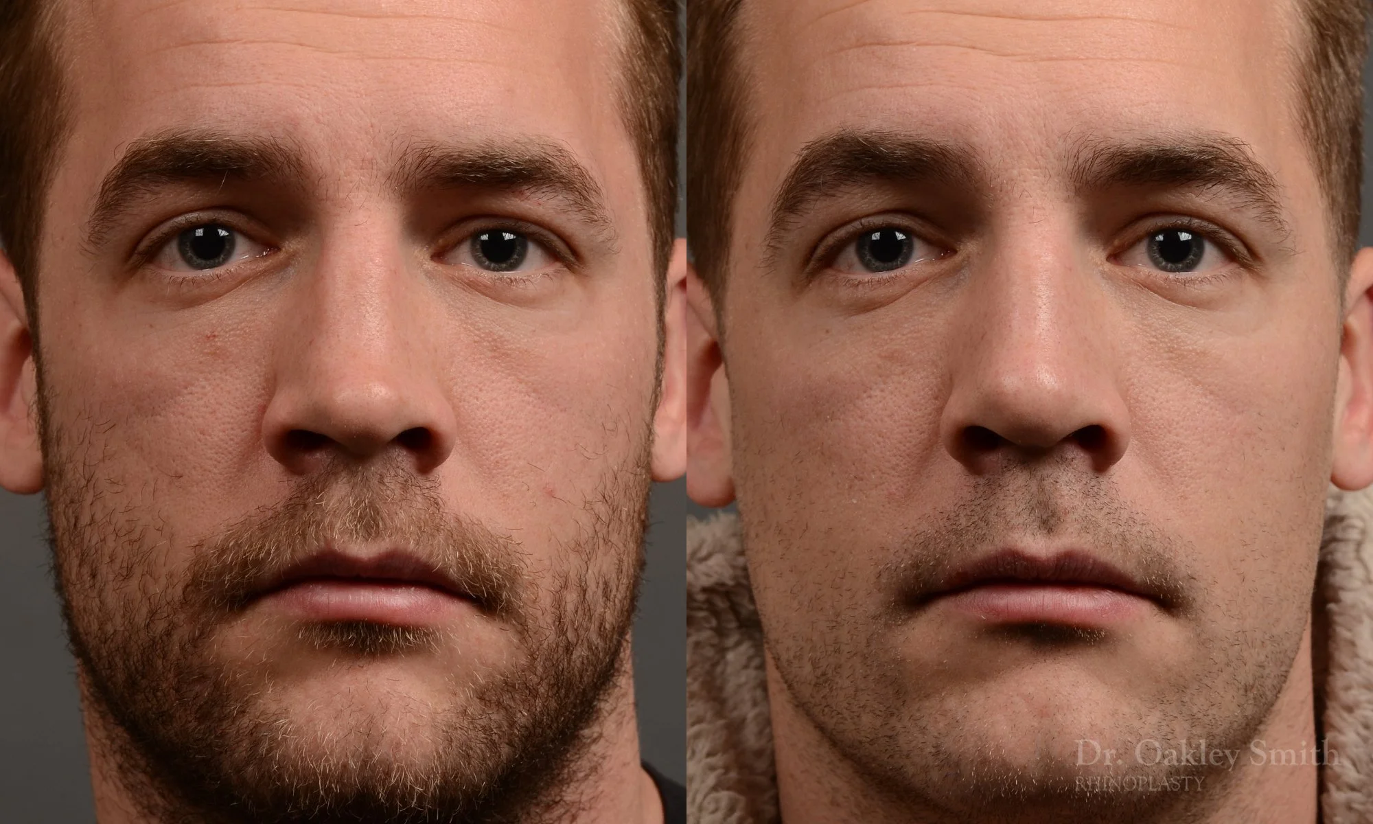388A-rhinoplasty-dr-oakley-smith-toronto-nose-job.jpg