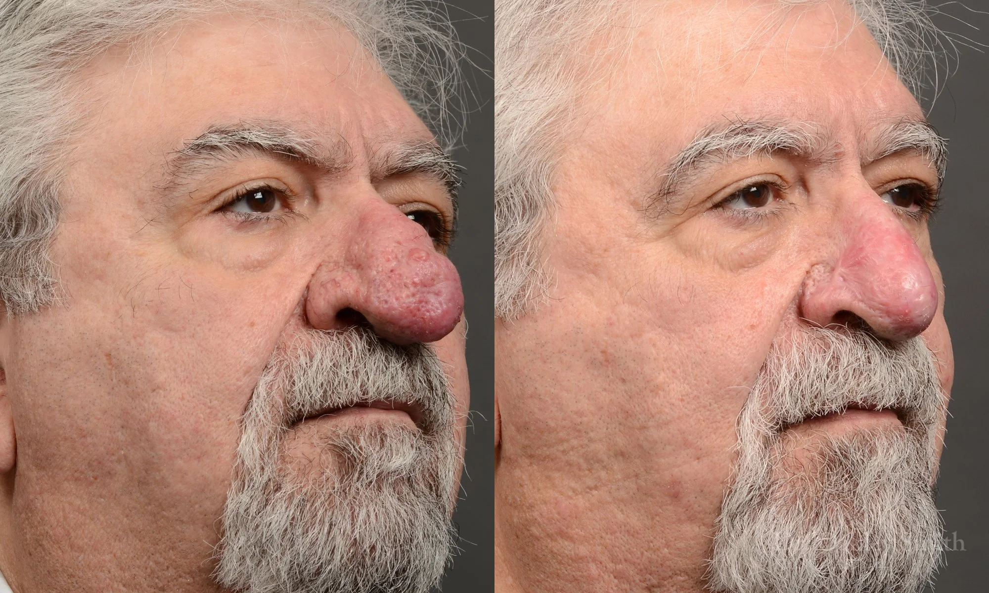 Case 562, Dr. Oakley Smith, rhinophyma rhinoplasty, 12 months after surgery, right oblique view