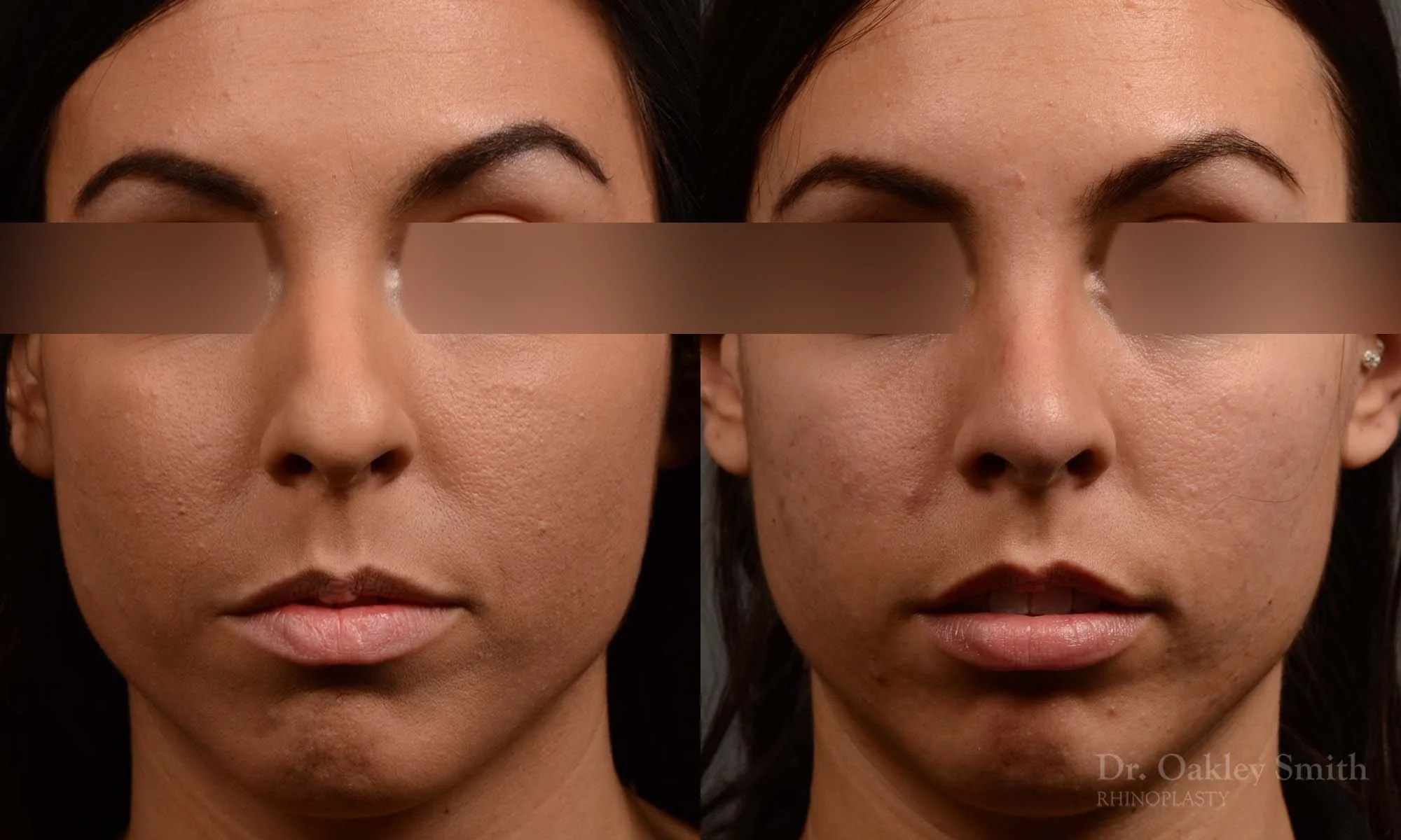 320A-rhinoplasty-dr-oakley-smith-toronto-nose-job.jpg