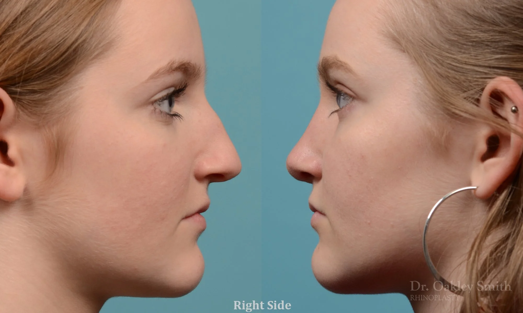 314: Female, Primary Rhinoplasty, Dorsal Bump, Tip Rotation, Crooked