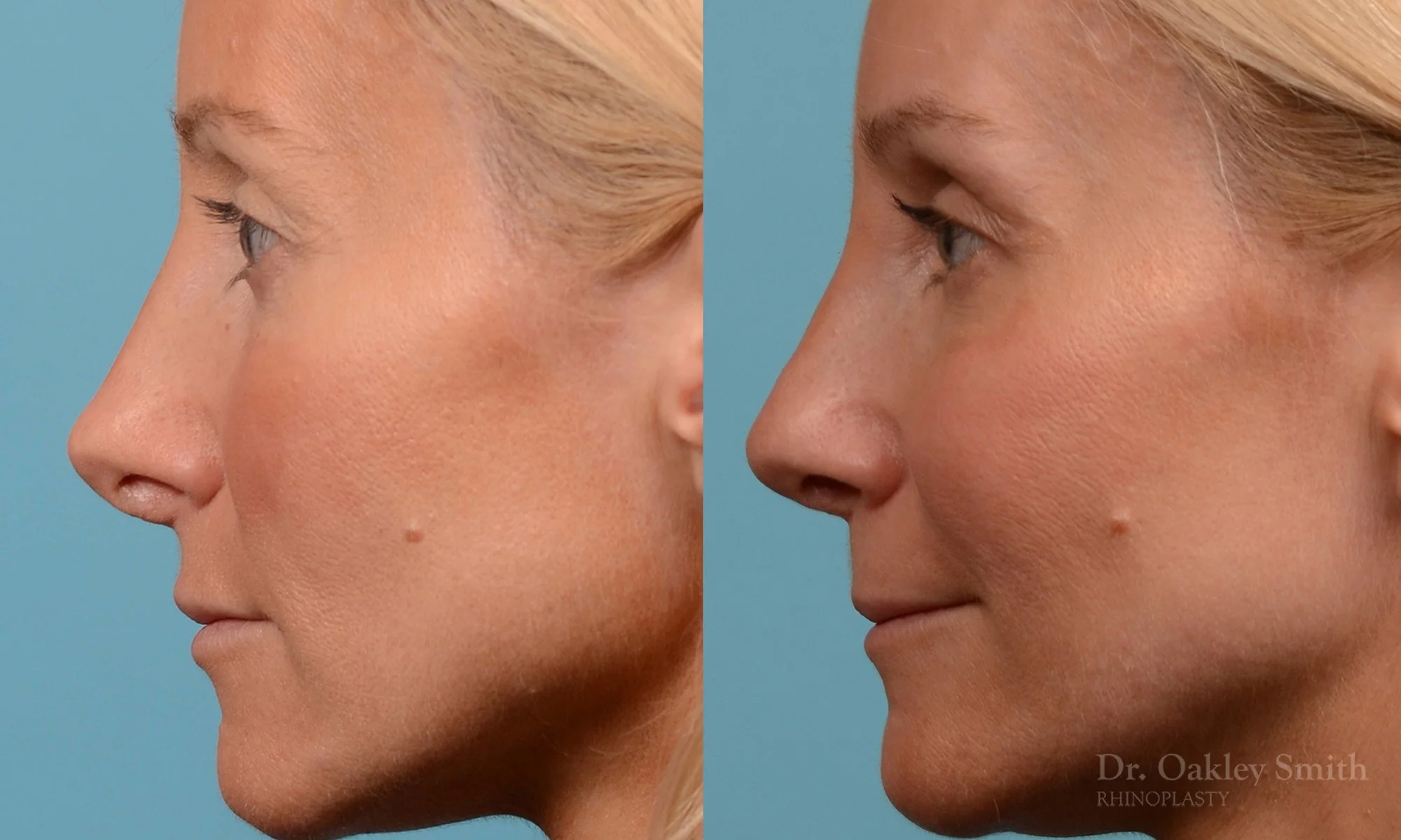 232E-rhinoplasty-dr-oakley-smith-nose-job-large-nose-long-nose-1.jpg