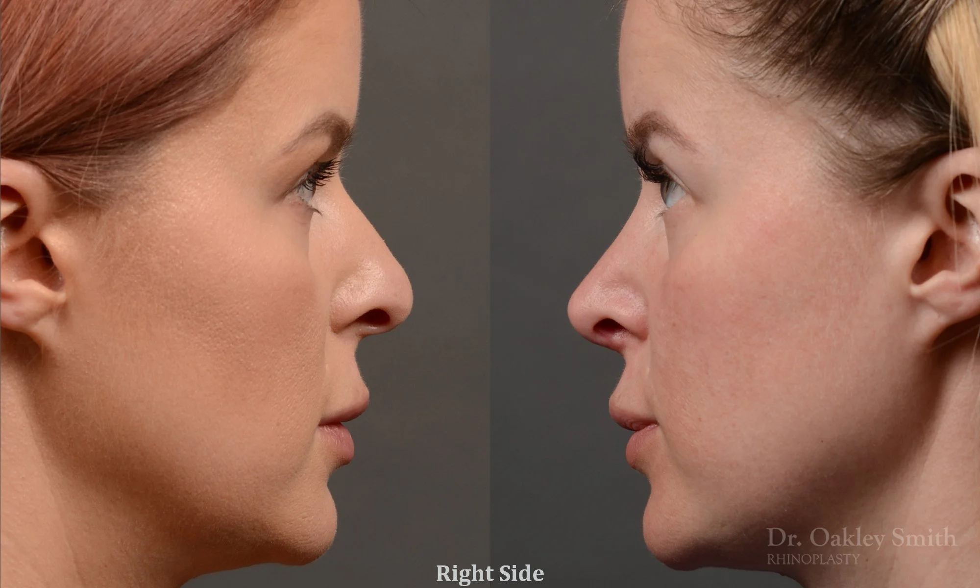 361C-rhinoplasty-dr-oakley-smith-toronto-nose-job.jpg