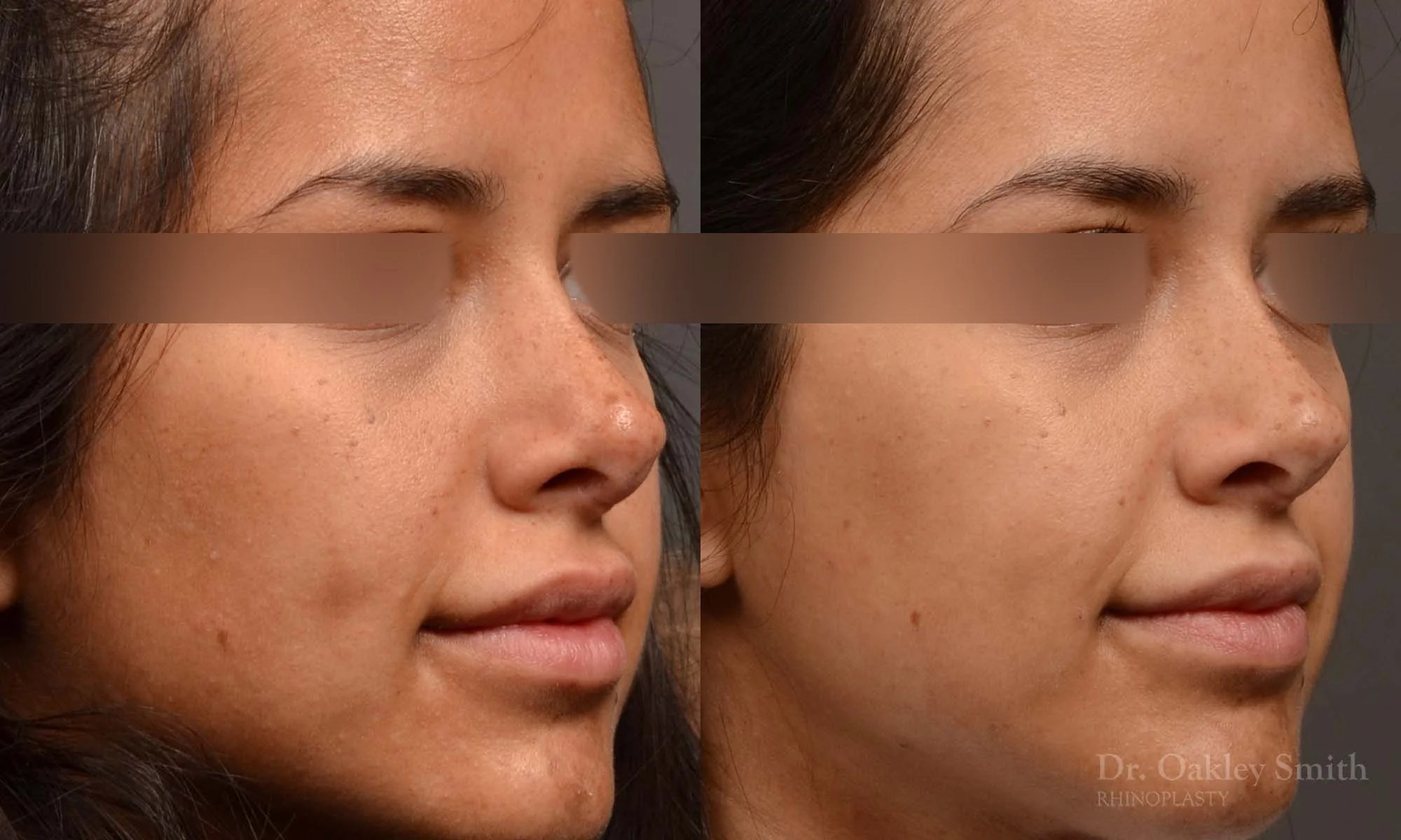 492B-rhinoplasty-dr-oakley-smith-toronto-top-surgeon-nose-job.jpg