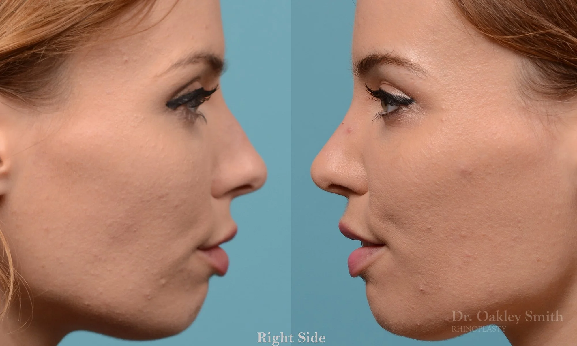 231C-rhinoplasty-dr-oakley-smith-toronto-nose-job-long-nose-bump-bridge-2.jpg