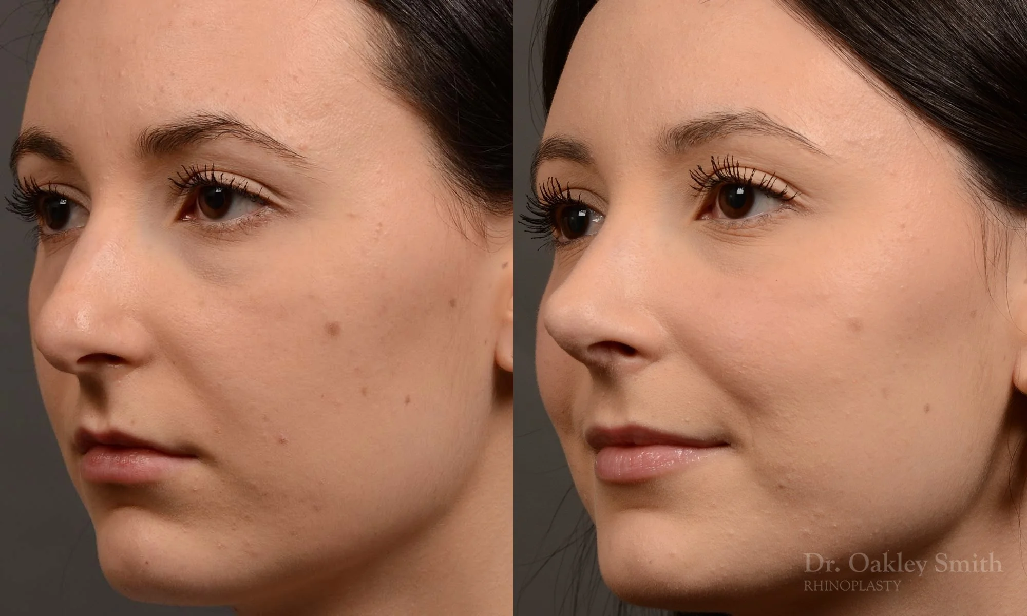 449.1D-revision-rhinoplasty-dr-oakley-smith-toronto-top-surgeon-nose-job.jpg