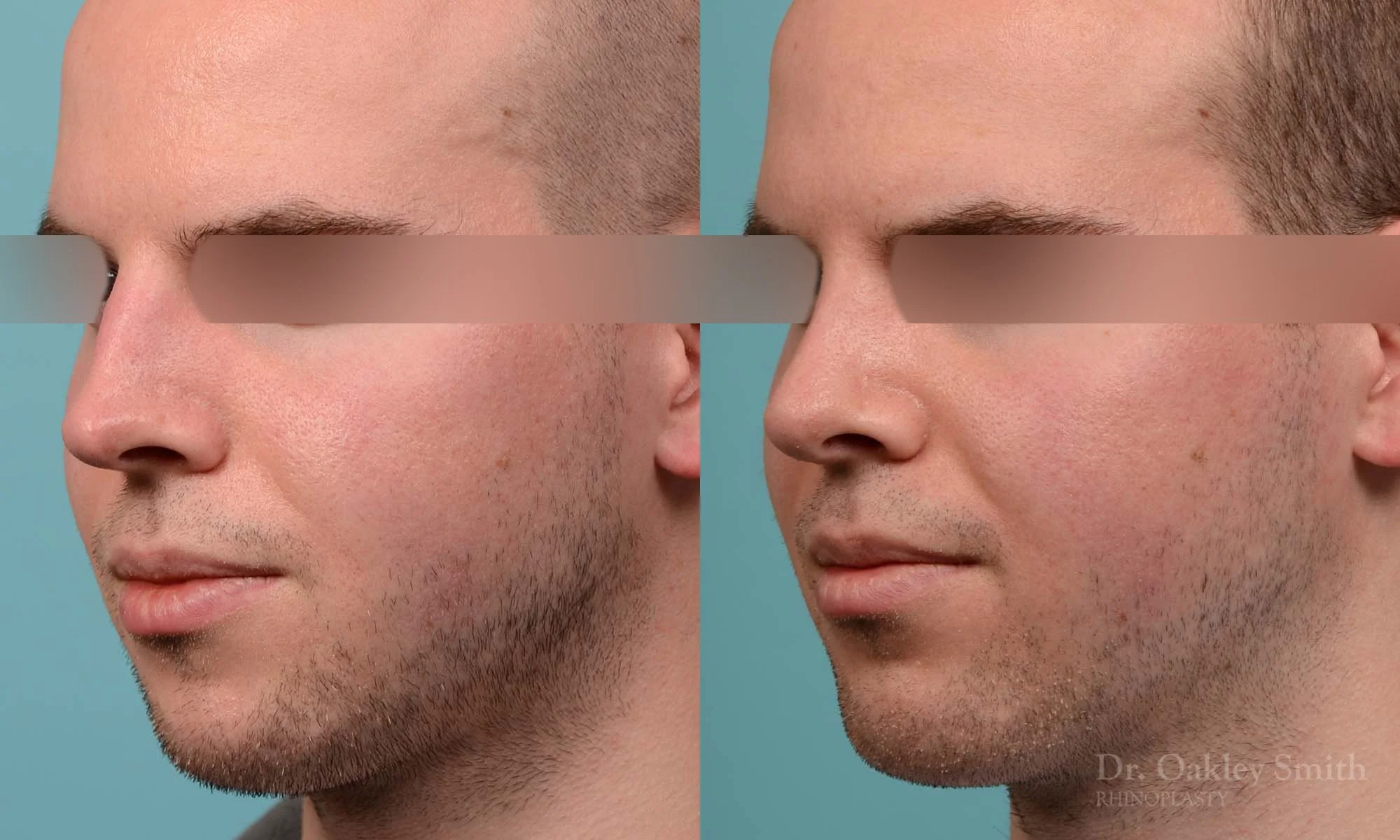 278D-rhinoplasty-dr-oakley-smith-toronto-male-nose-job.jpg