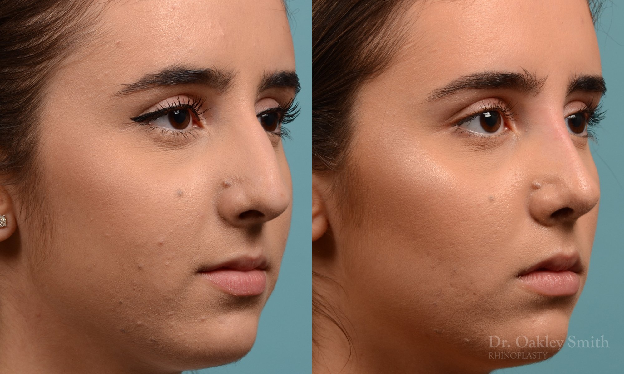 301B-rhinoplasty-dr-oakley-smith-toronto-nose-job (1).jpg