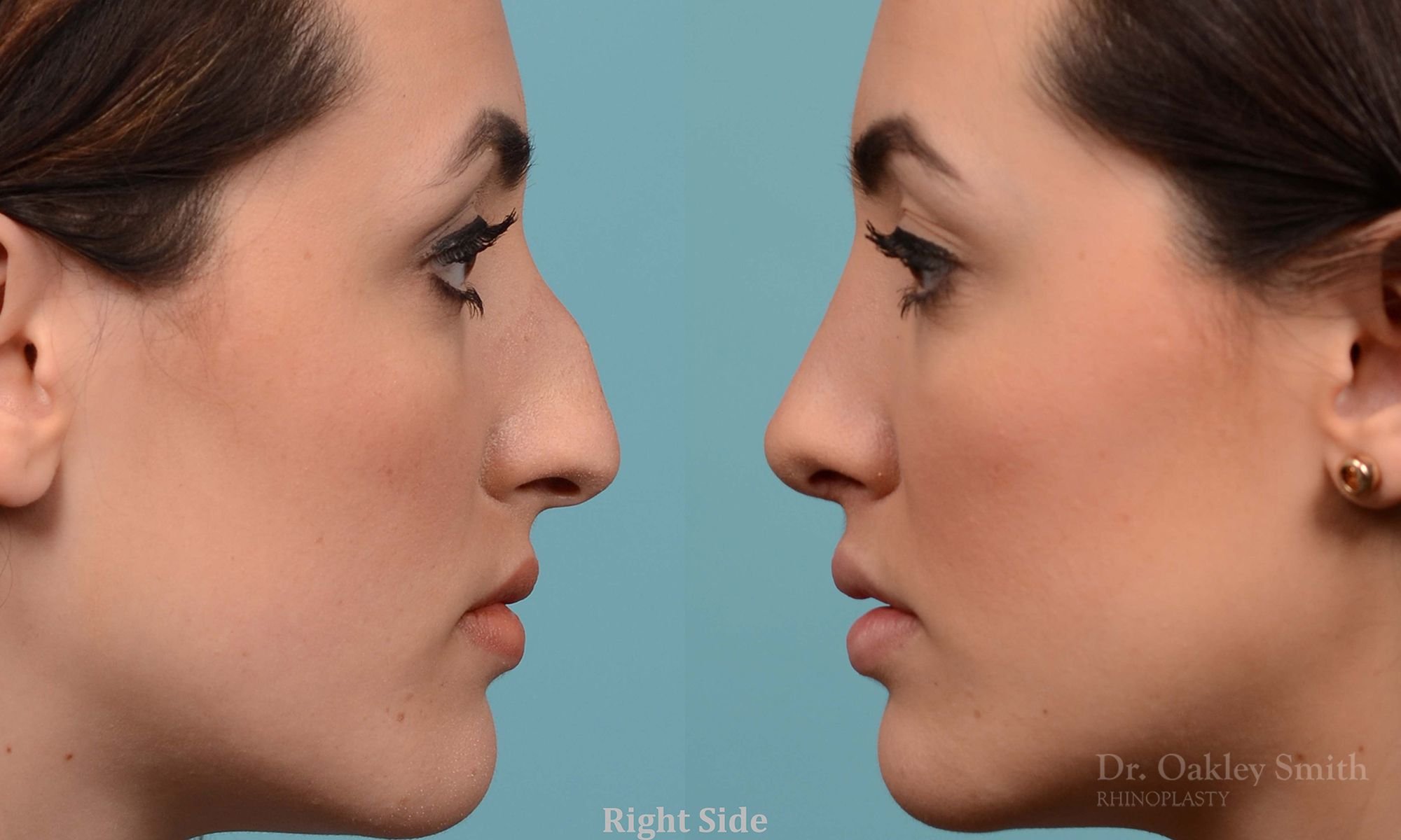 230: Female, Primary Rhinoplasty, Dorsal Bump, Tip Rotation, Crooked
