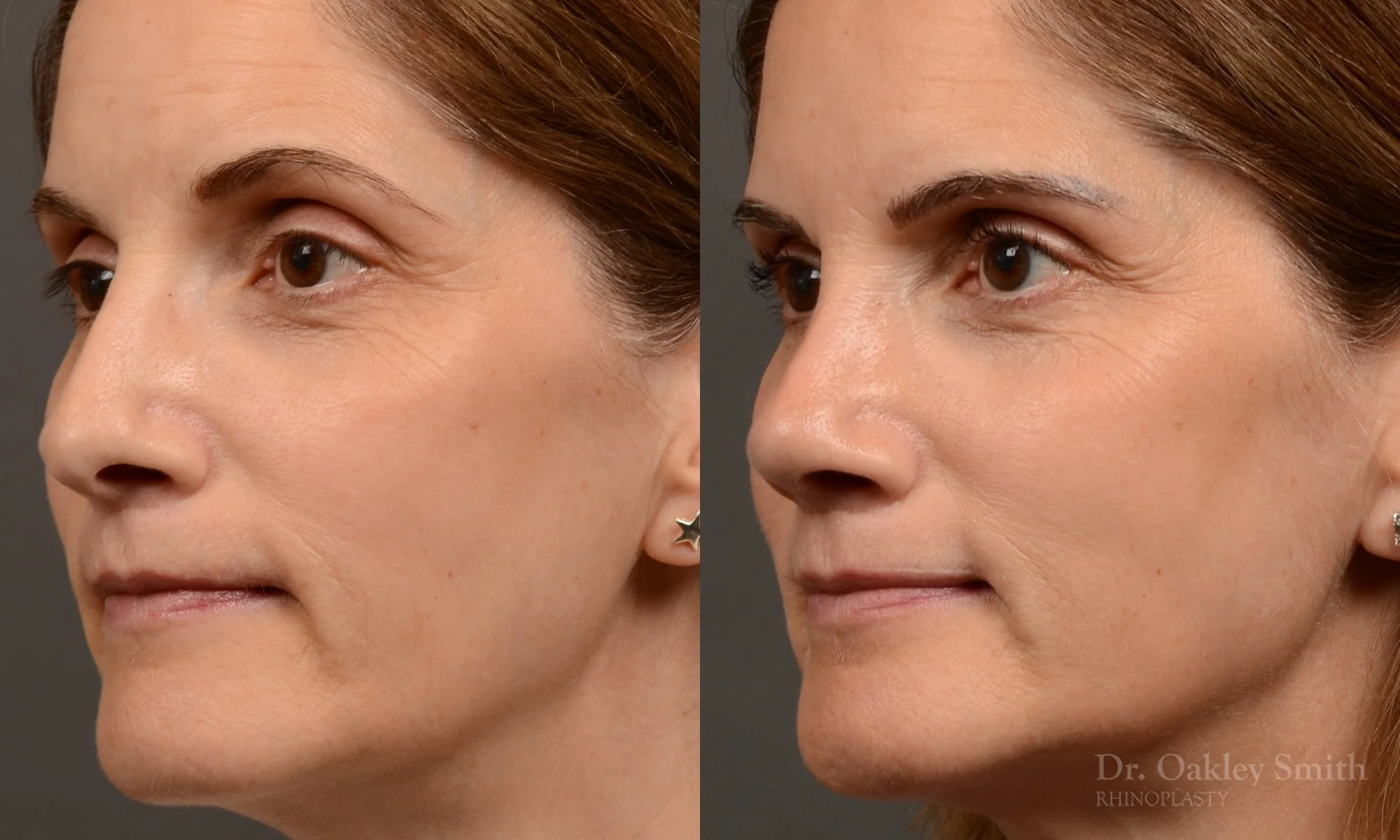 546D-rhinoplasty-nose-job-top-toronto-surgeon-dr-oakley-smith.jpg