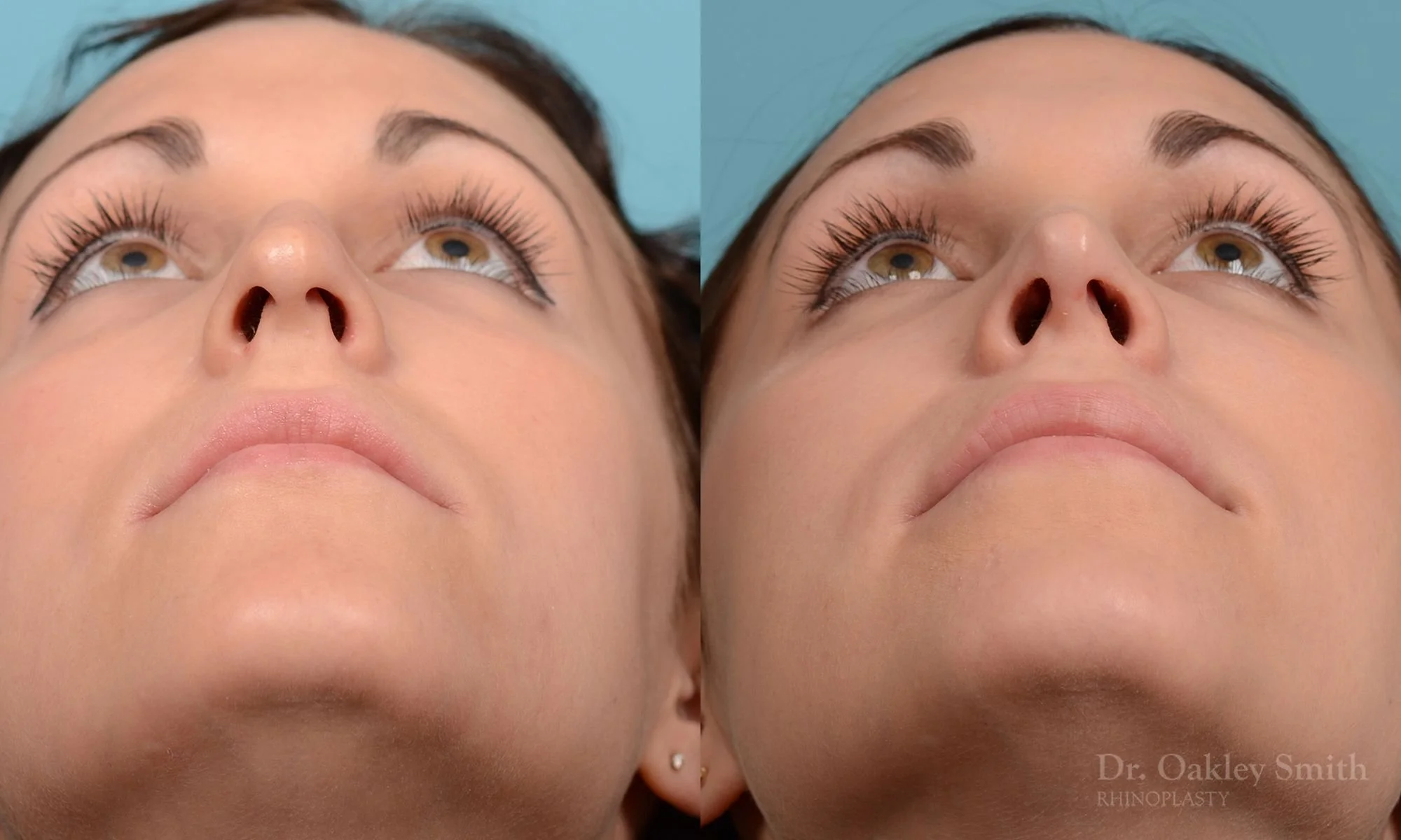 224F-rhinoplasty-nose-job-dr-oakley-smith-toronto-long-nose-large-nose-straight-nose-bridge-1.jpg