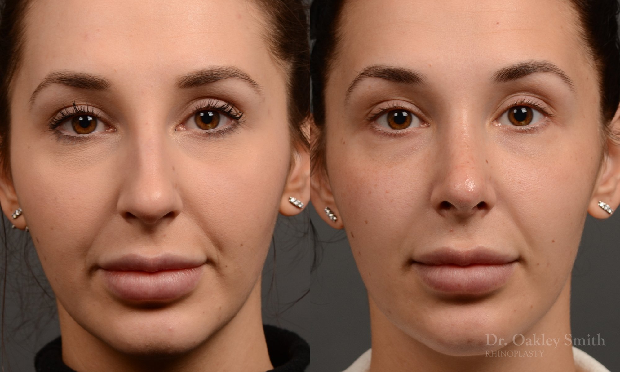 294A-rhinoplasty-dr-oakley-smith-toronto-nose-job.jpg